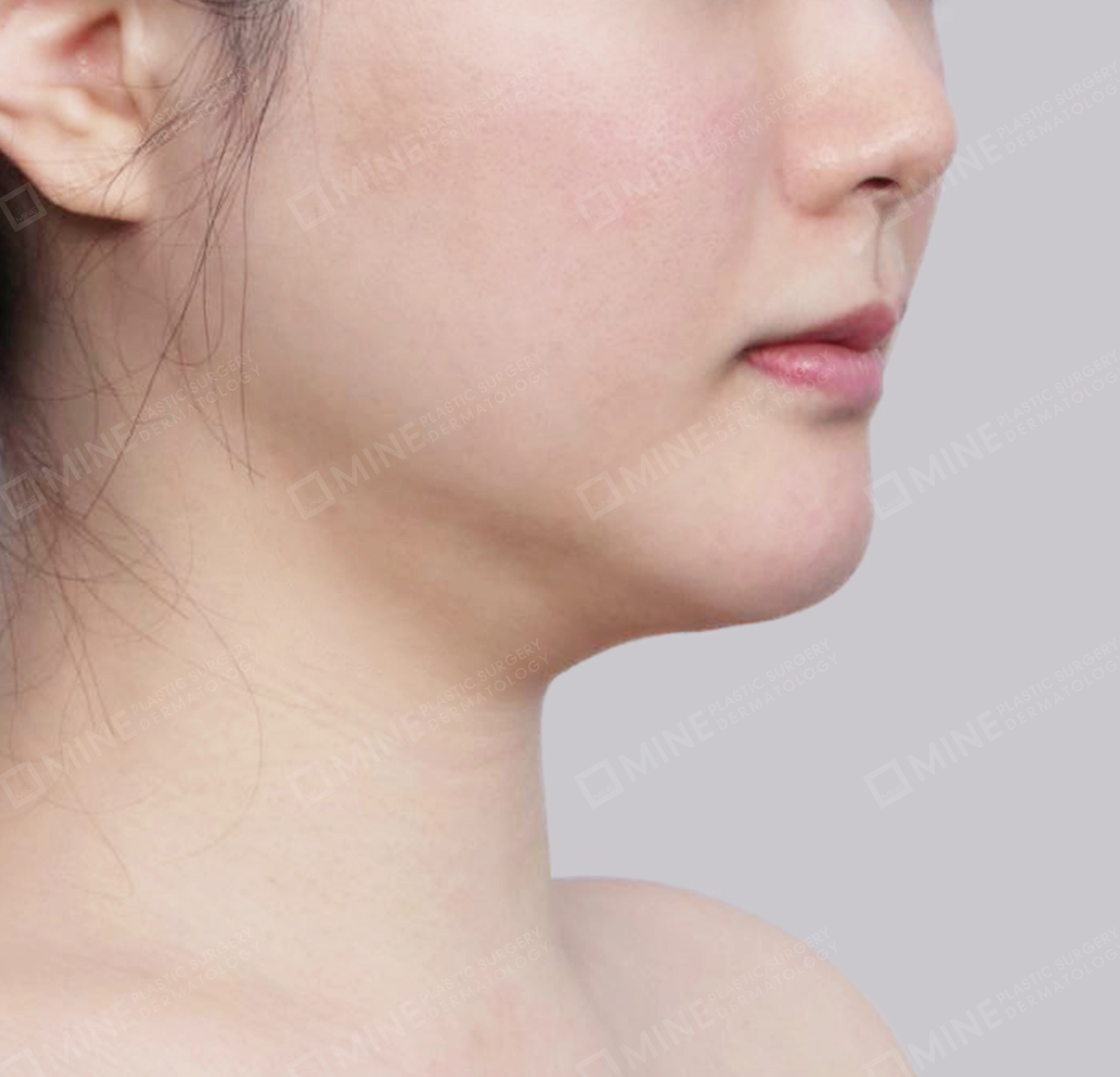 Hút mỡ nọng, cắt tuyến nước bọt-정면-전