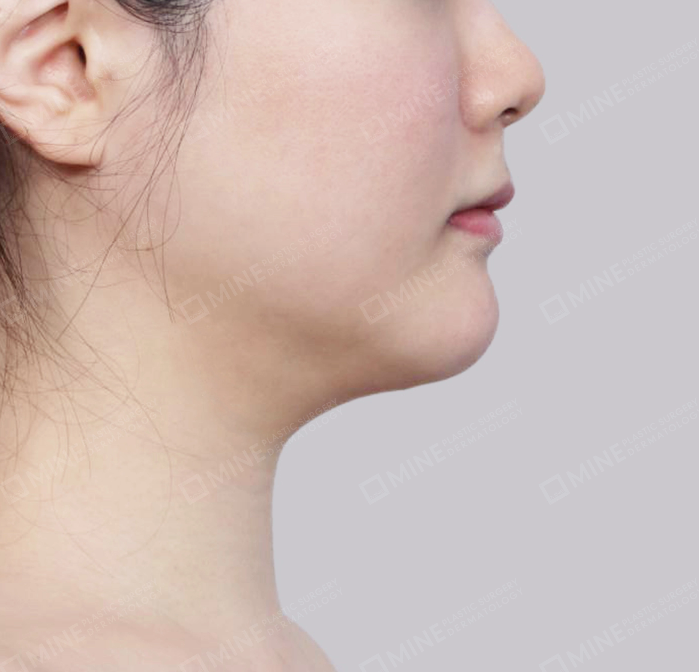 Hút mỡ nọng, cắt tuyến nước bọt-측면-전