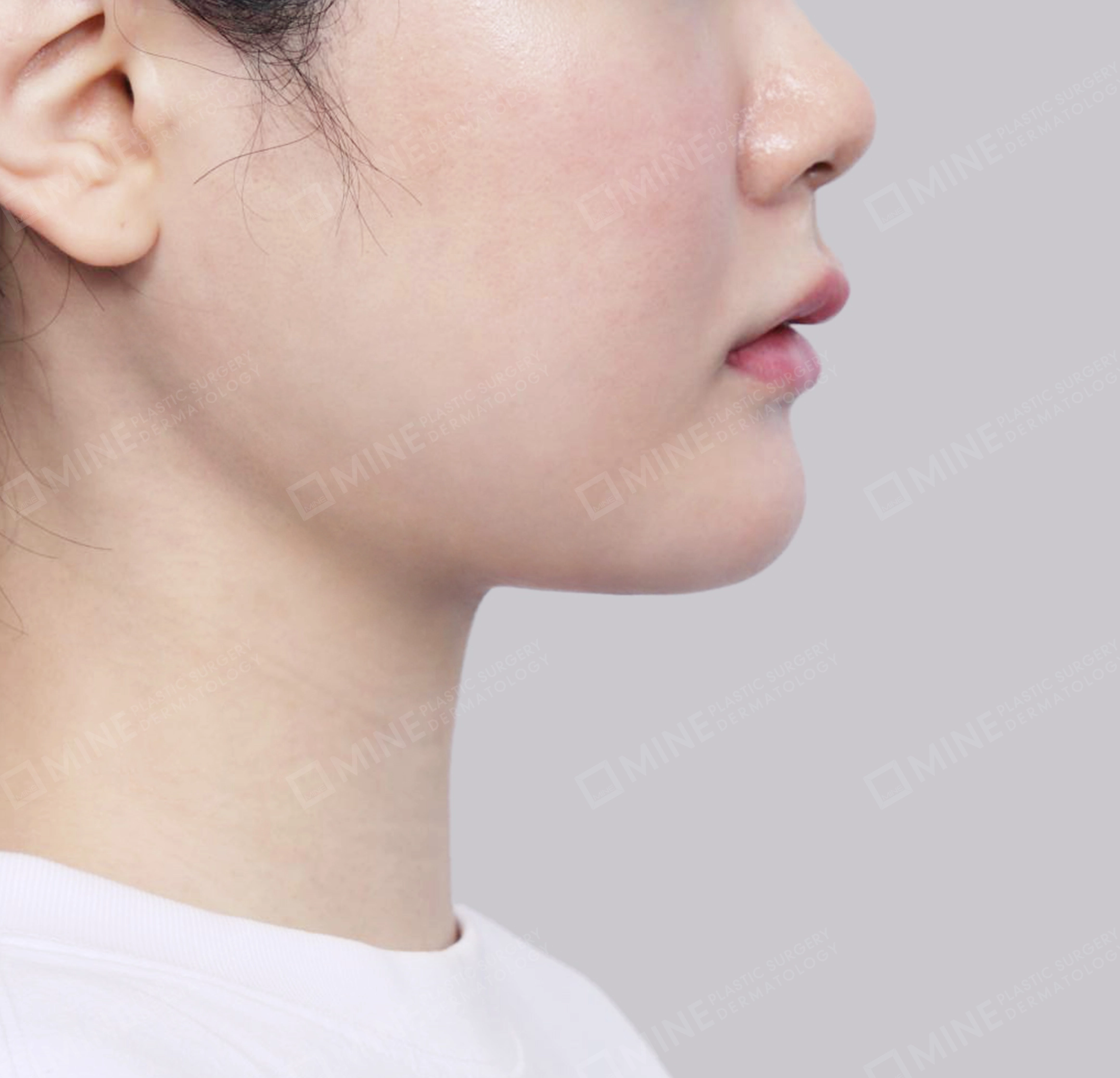 Hút mỡ nọng, cắt tuyến nước bọt-측면-후