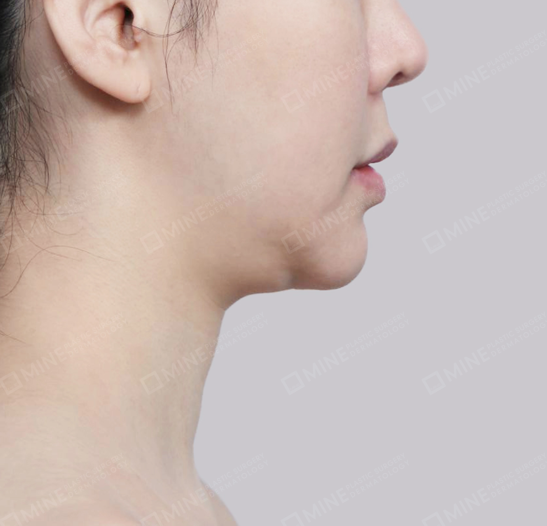 Hút mỡ nọng, cắt tuyến nước bọt-측면-전