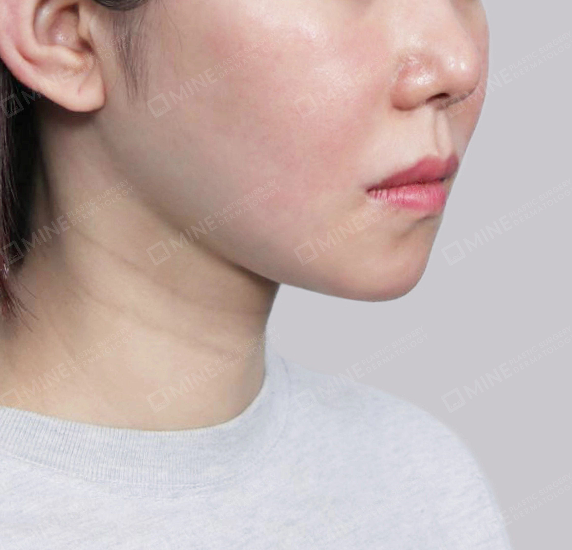 Hút mỡ nọng, cắt tuyến nước bọt-정면-후