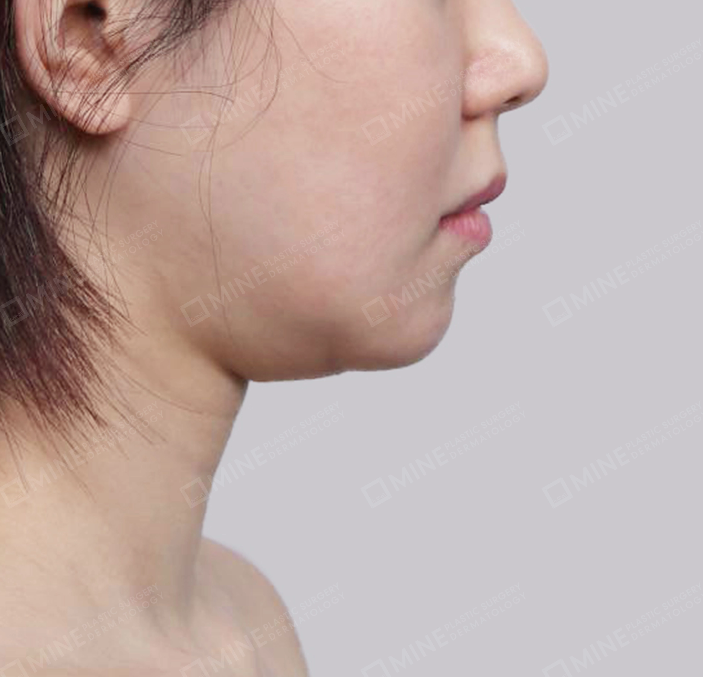 Hút mỡ nọng, cắt tuyến nước bọt-측면-전