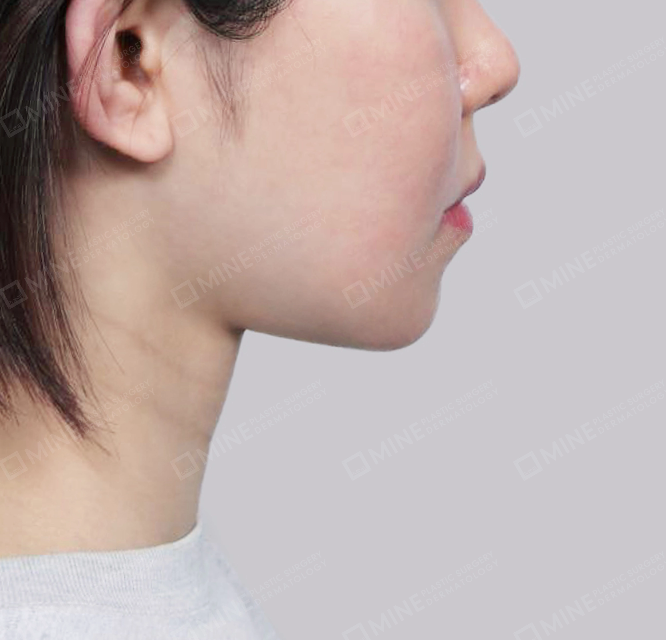 Hút mỡ nọng, cắt tuyến nước bọt-측면-후