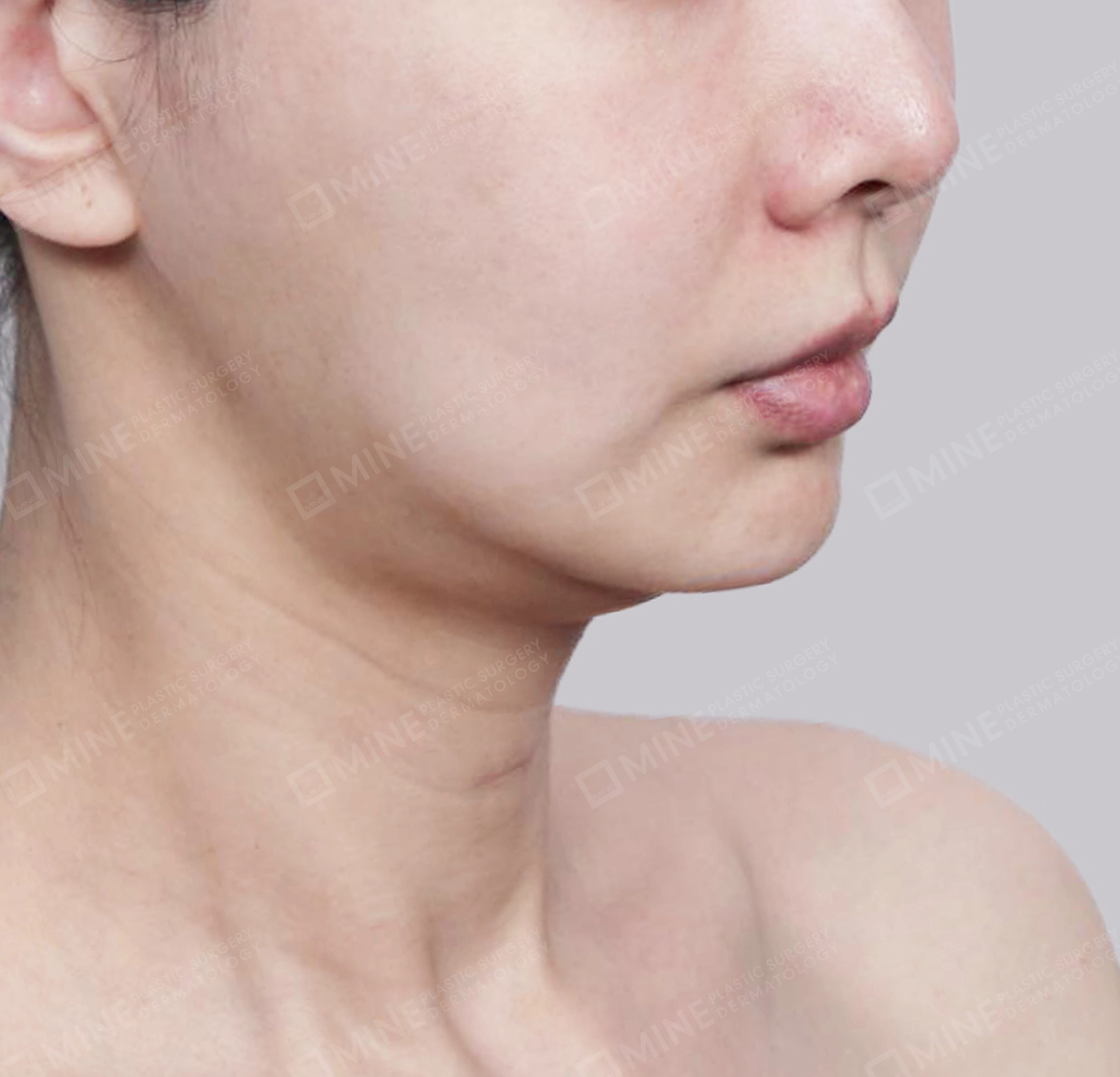 Hút mỡ nọng, cắt tuyến nước bọt-정면-전