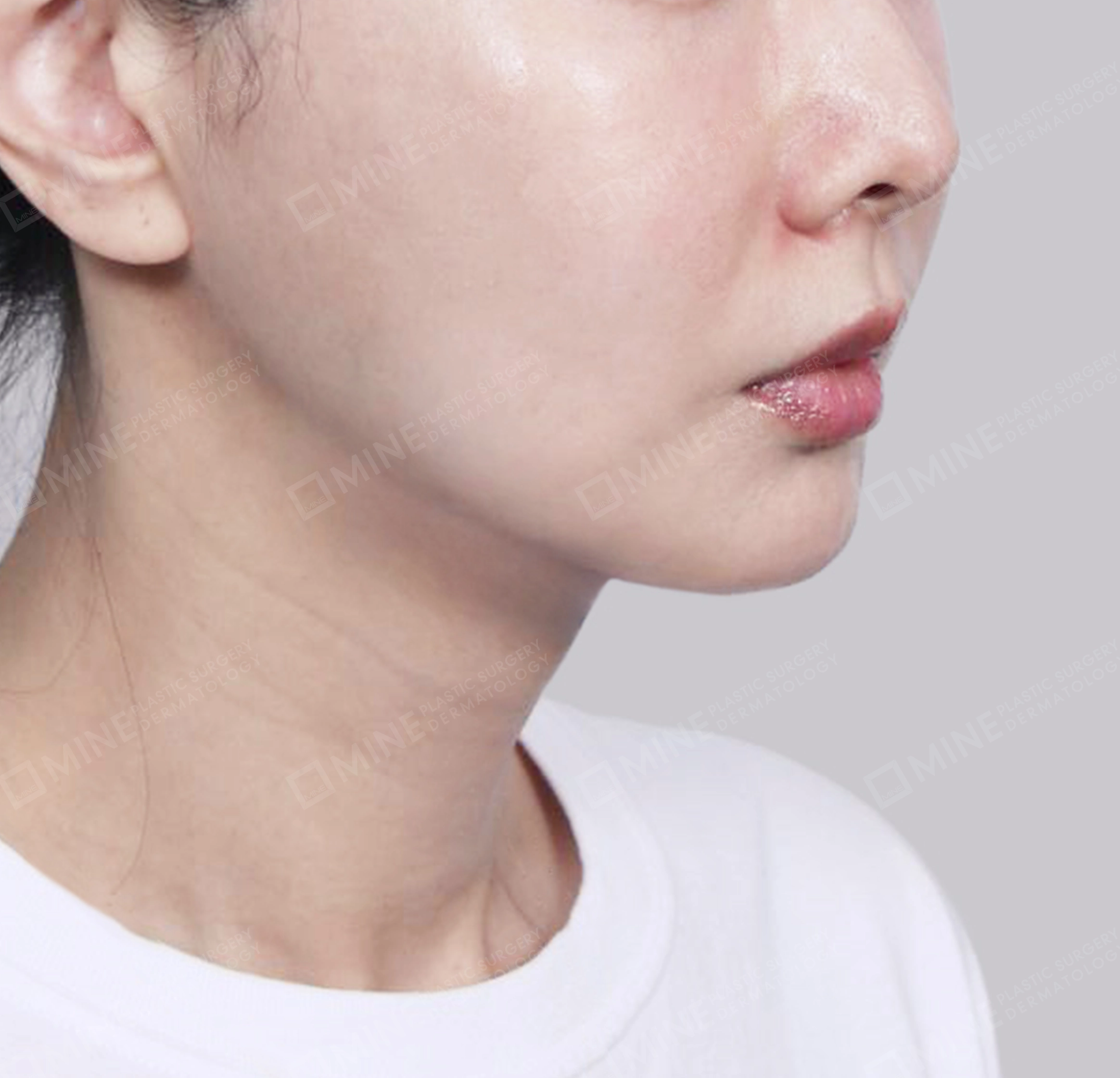 Hút mỡ nọng, cắt tuyến nước bọt-정면-후