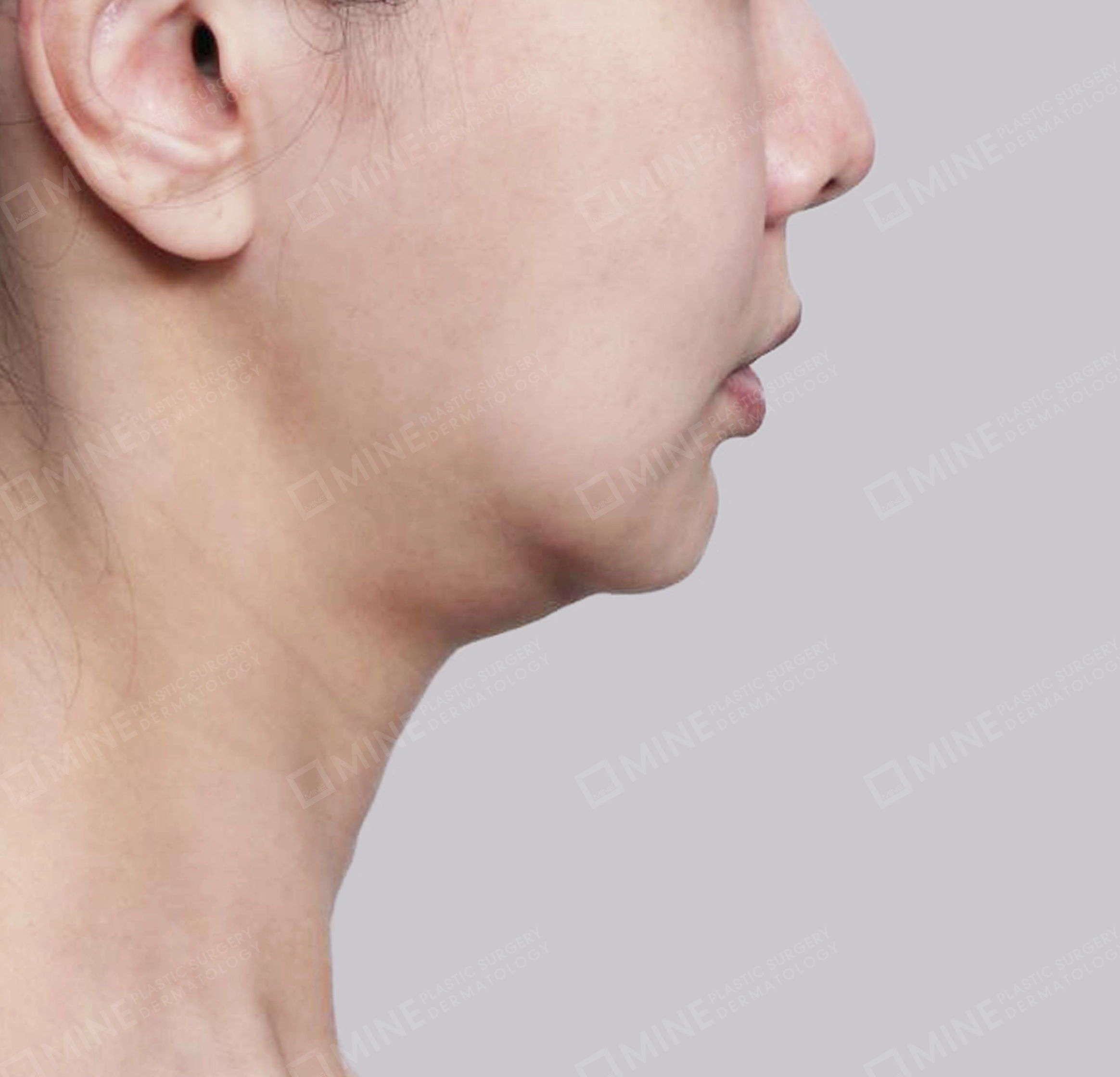 Hút mỡ nọng, cắt tuyến nước bọt-측면-전