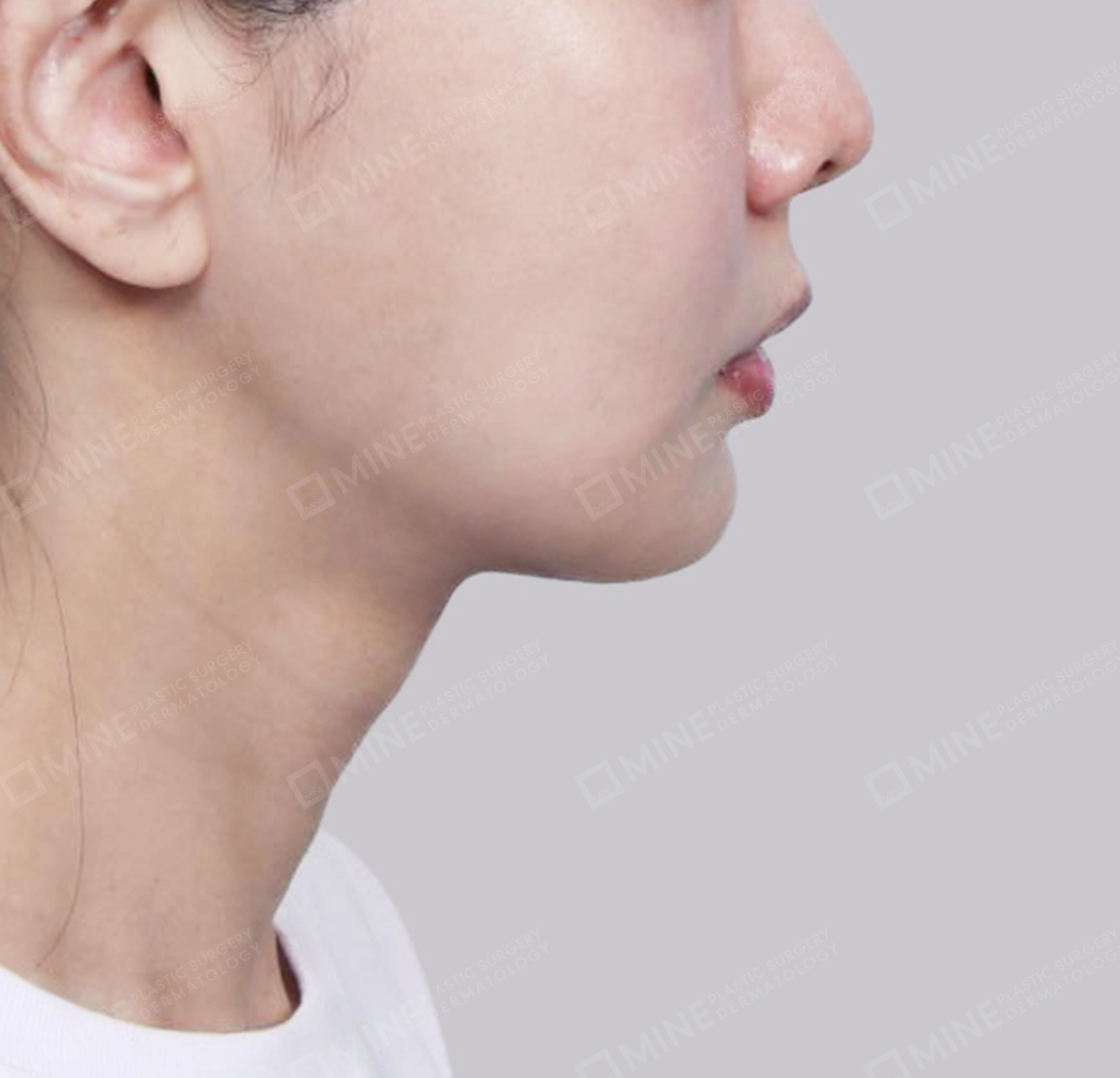 Hút mỡ nọng, cắt tuyến nước bọt-측면-후