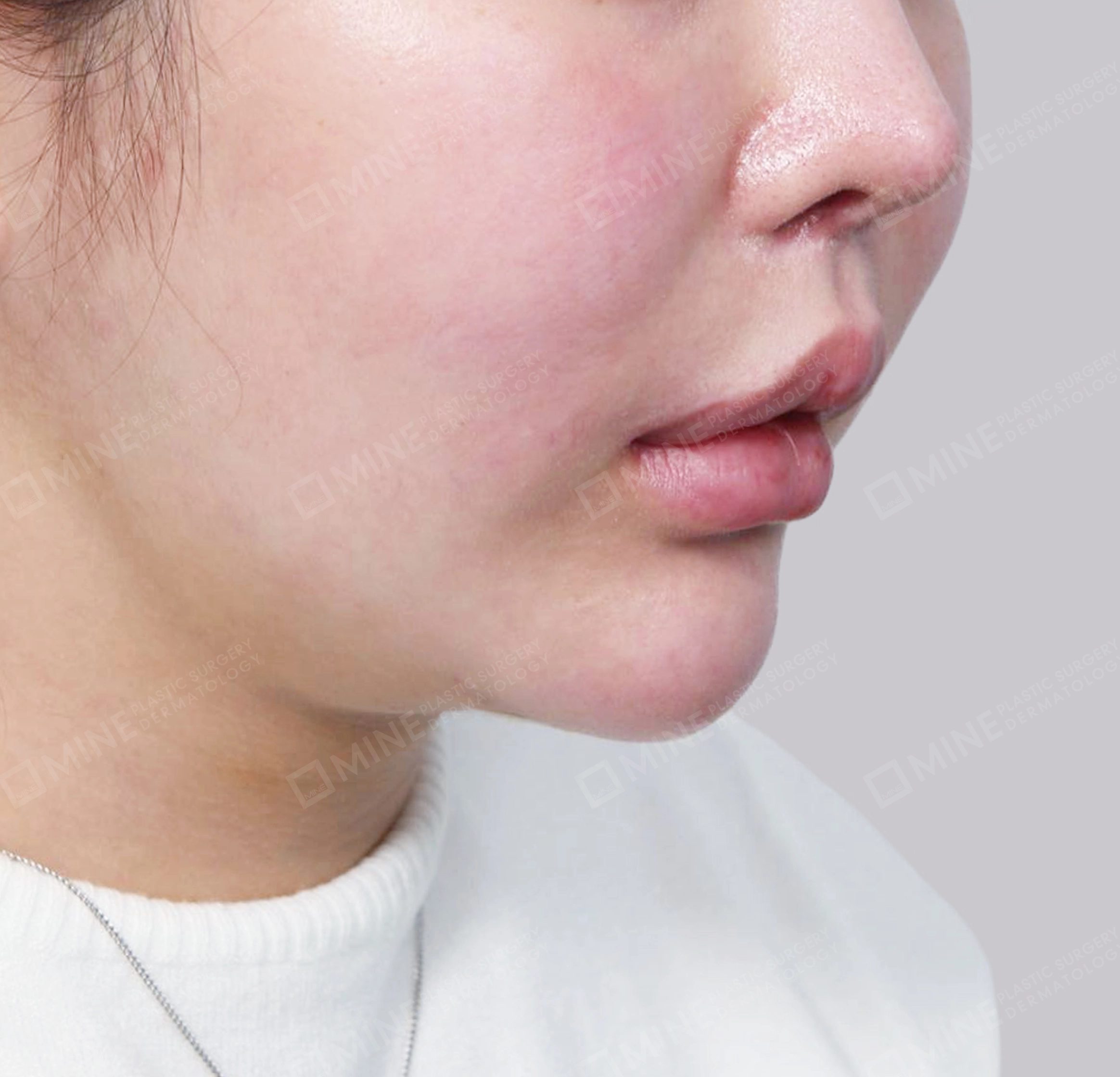 Hút mỡ nọng, cắt tuyến nước bọt-정면-전