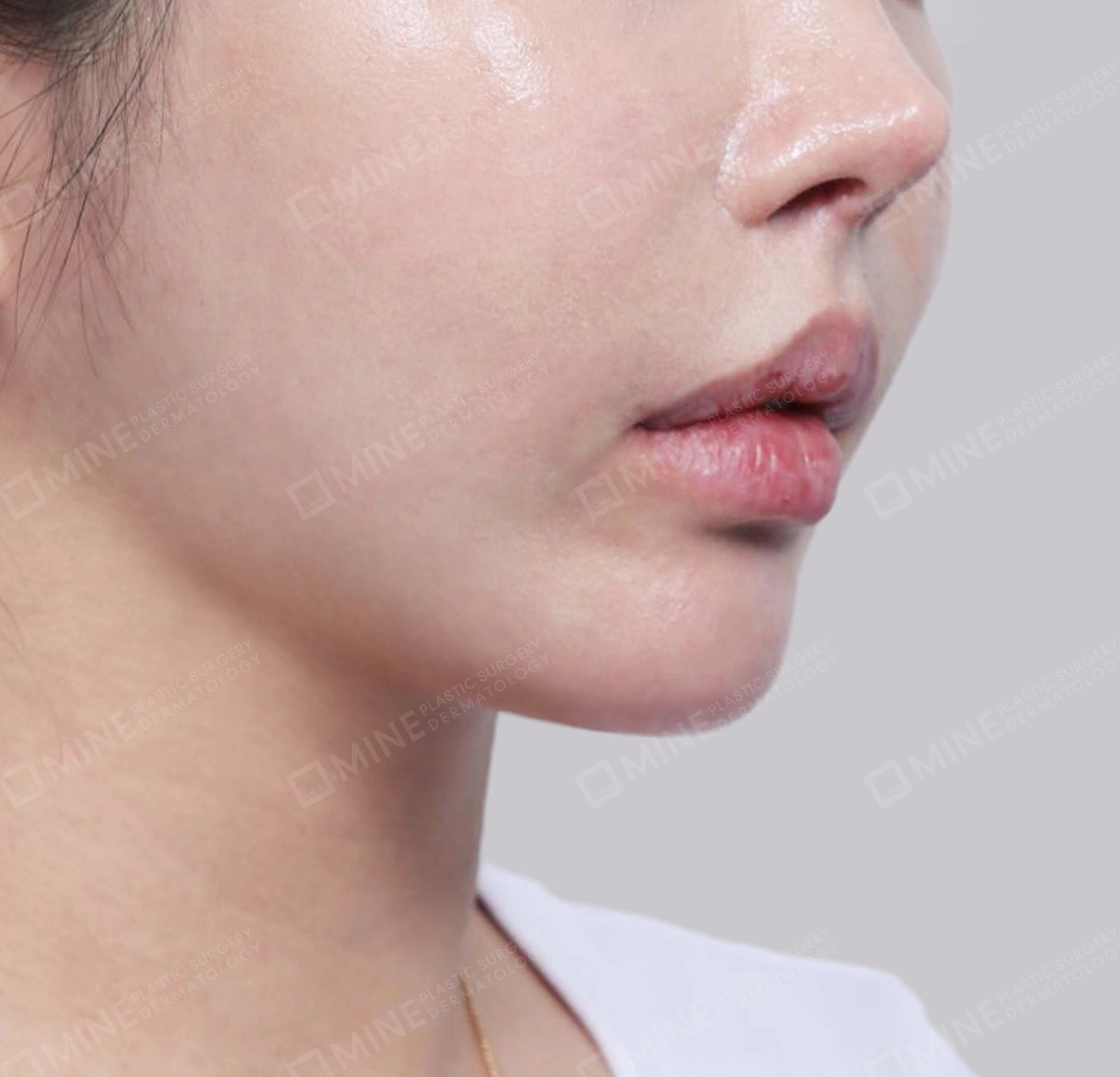 Hút mỡ nọng, cắt tuyến nước bọt-정면-후