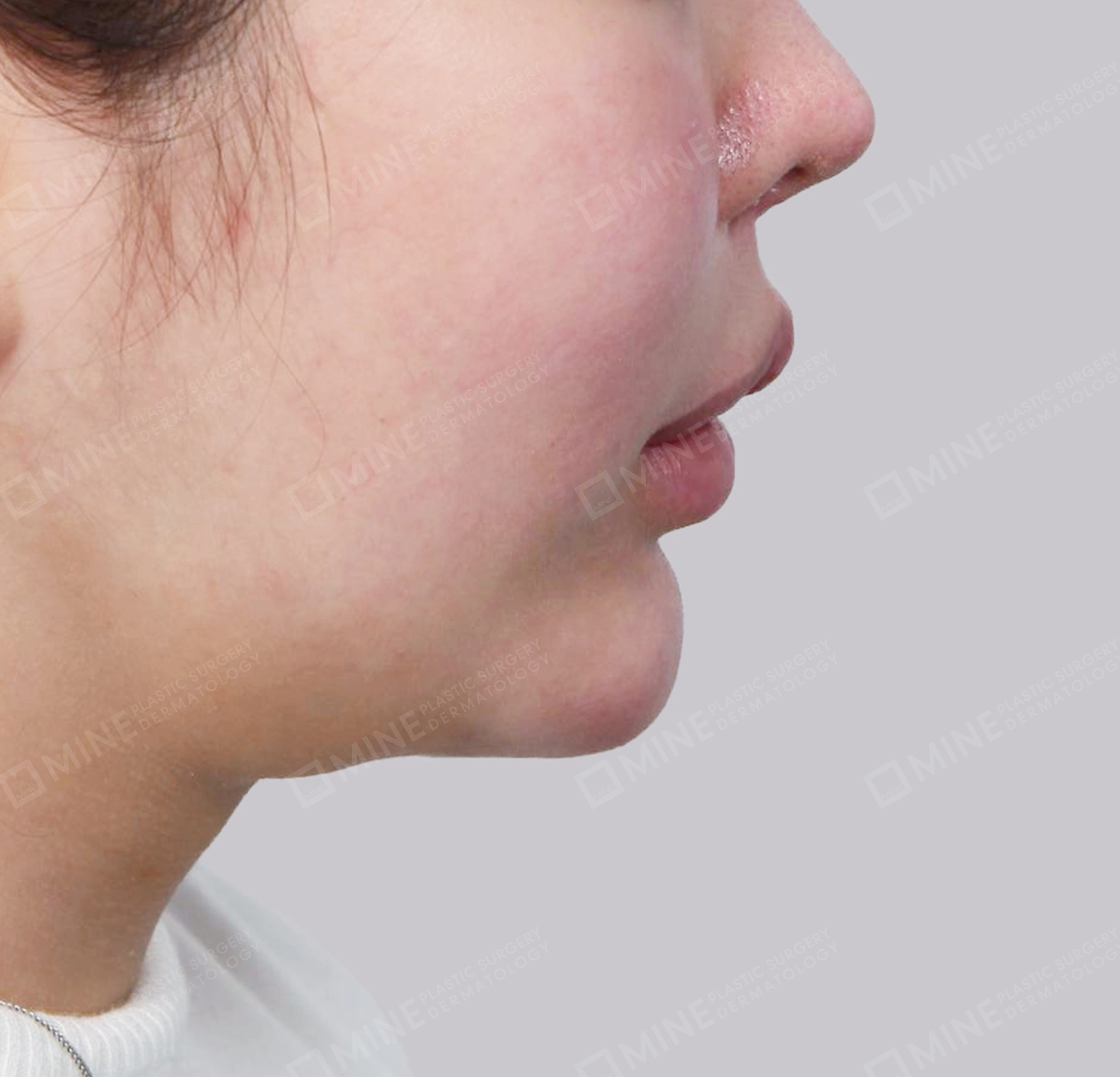 Hút mỡ nọng, cắt tuyến nước bọt-측면-전