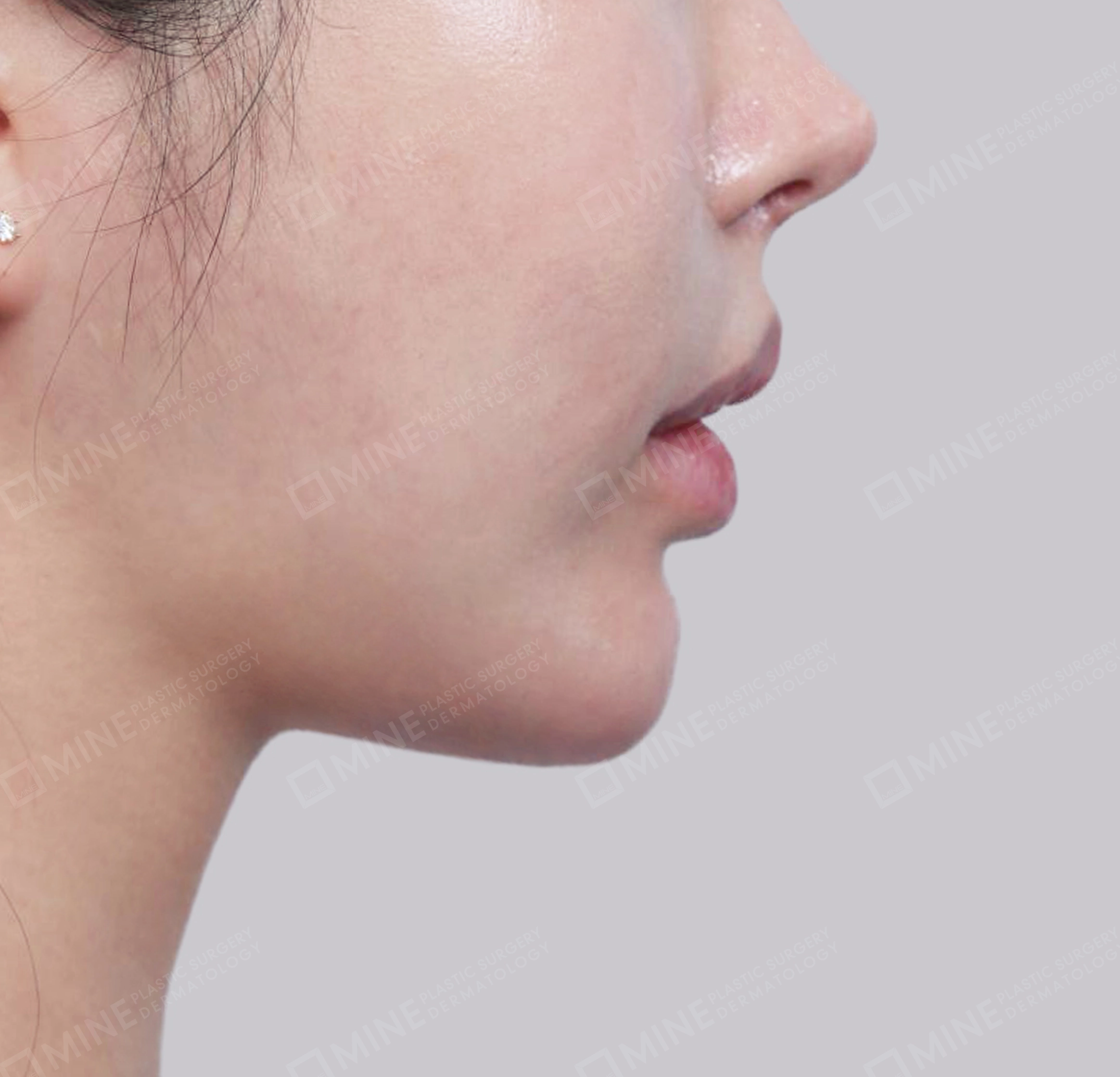 Hút mỡ nọng, cắt tuyến nước bọt-측면-후