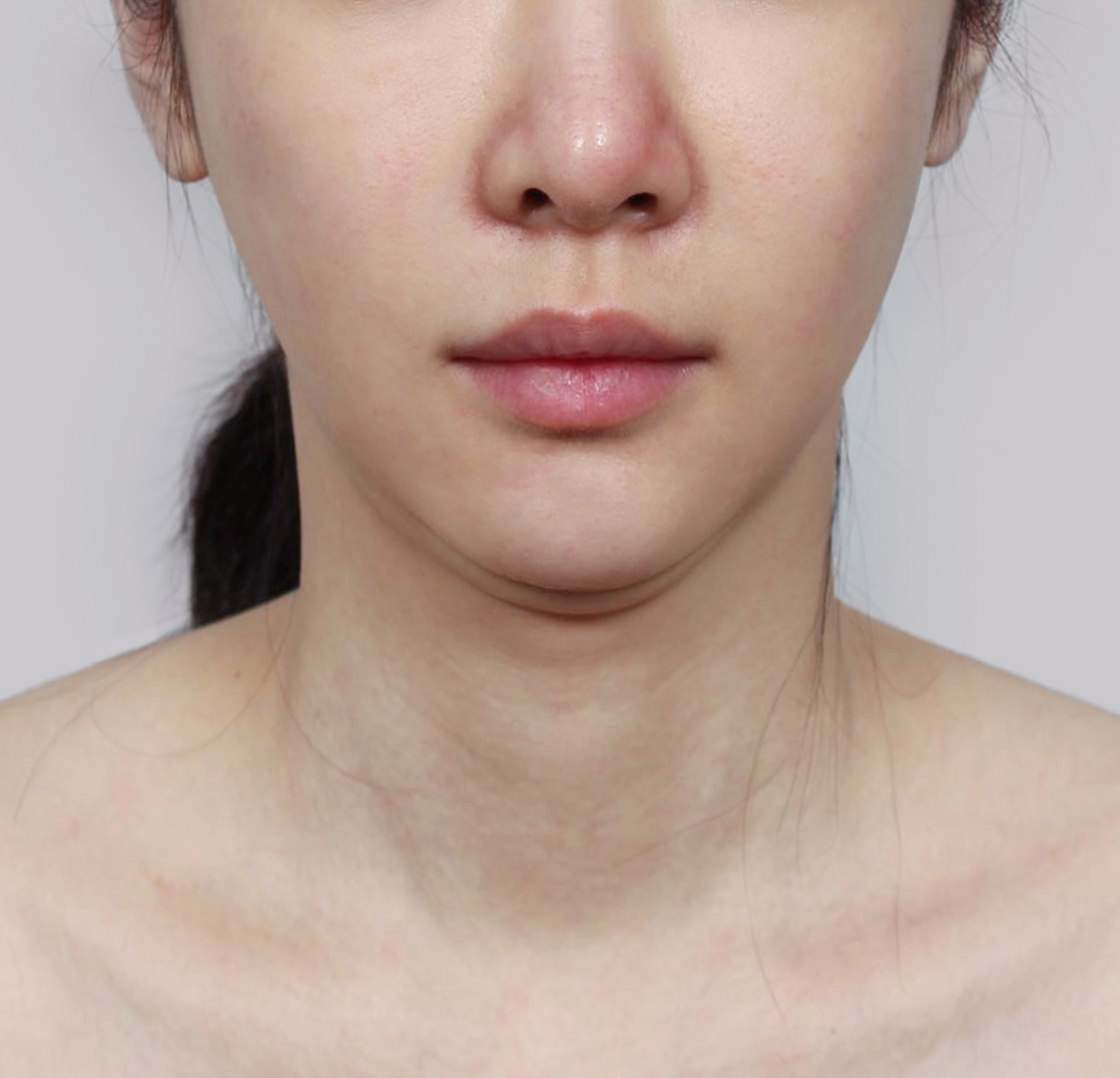 Căng Da Mặt Mini-정면-전