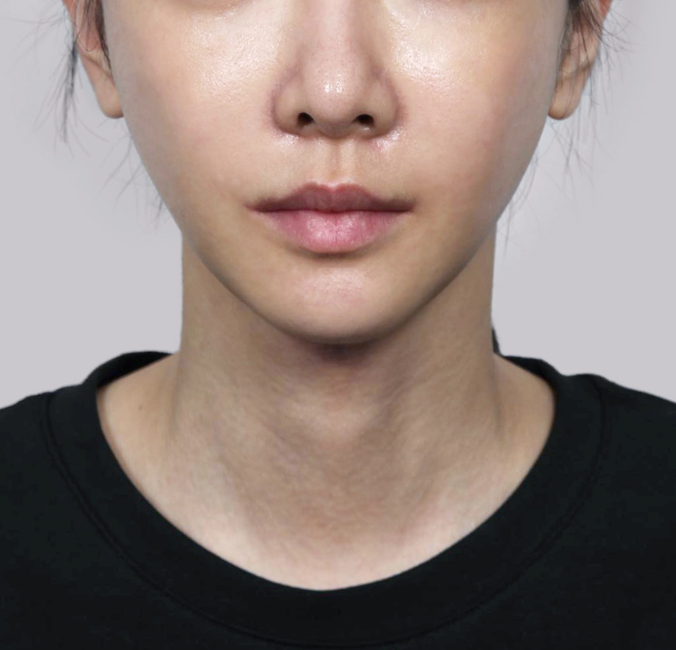 Căng Da Mặt Mini-정면-후