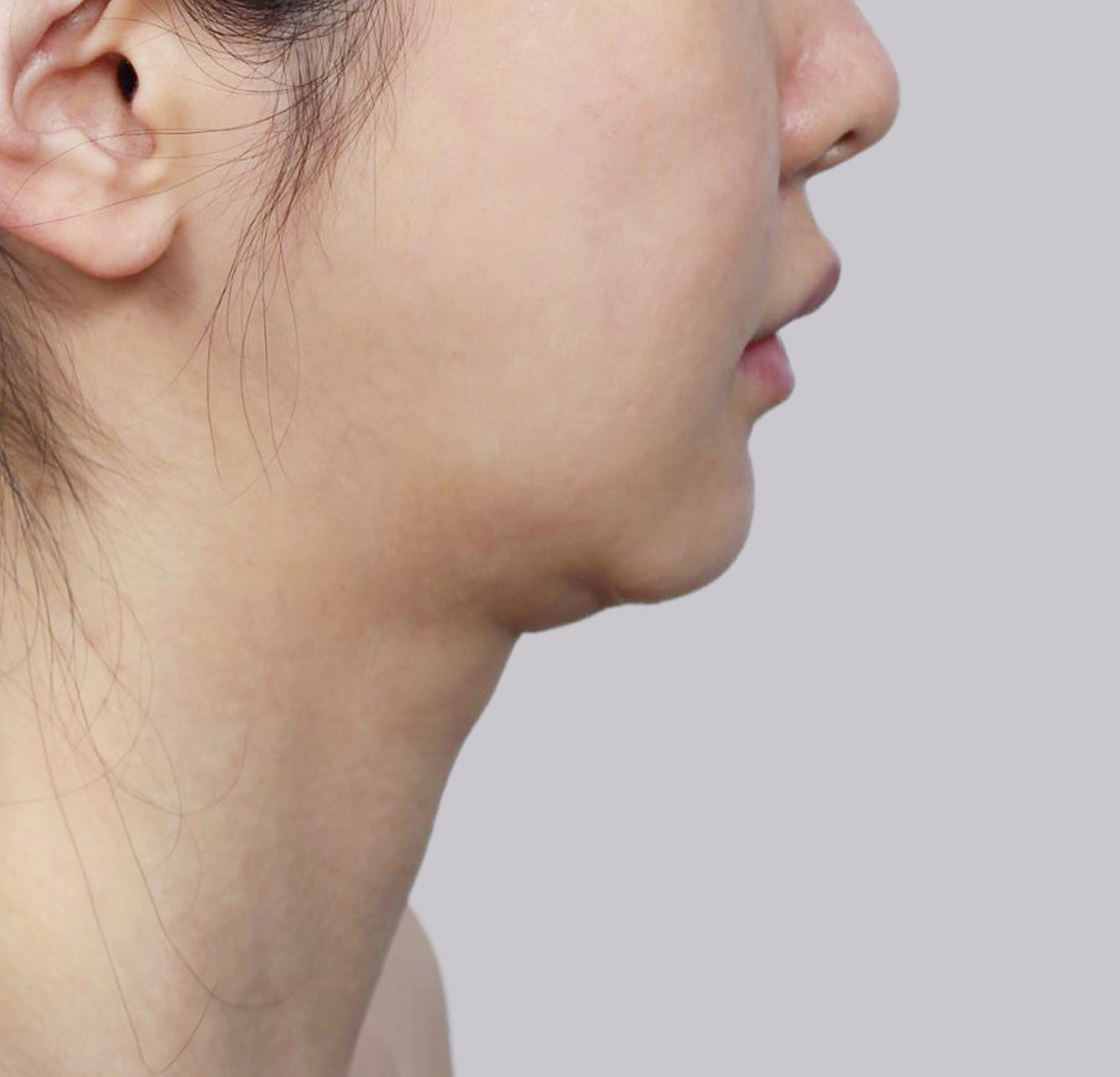 Căng Da Mặt Mini-측면-전