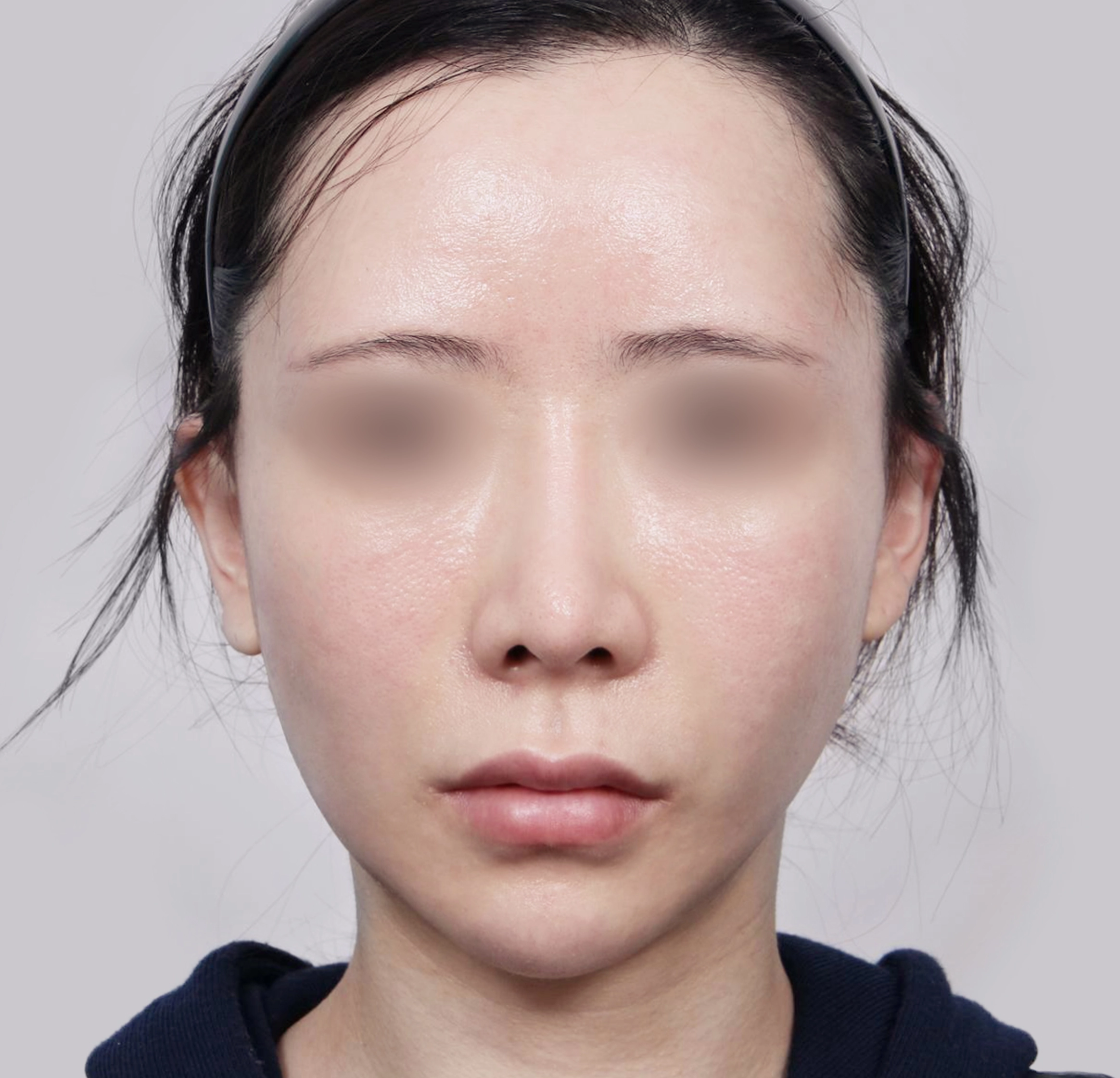 Căng Da Mặt Mini-정면-후