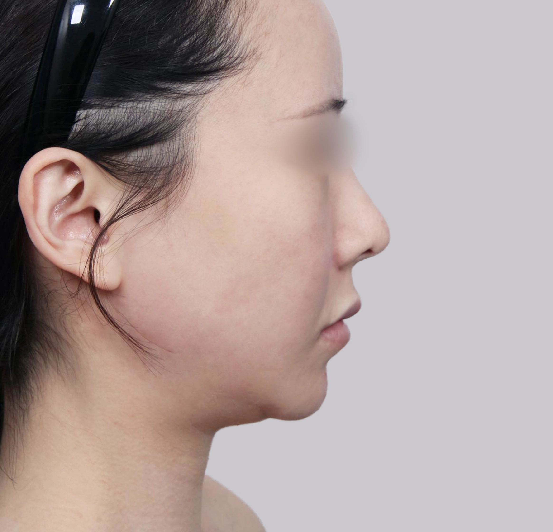 Căng Da Mặt Mini-측면-전