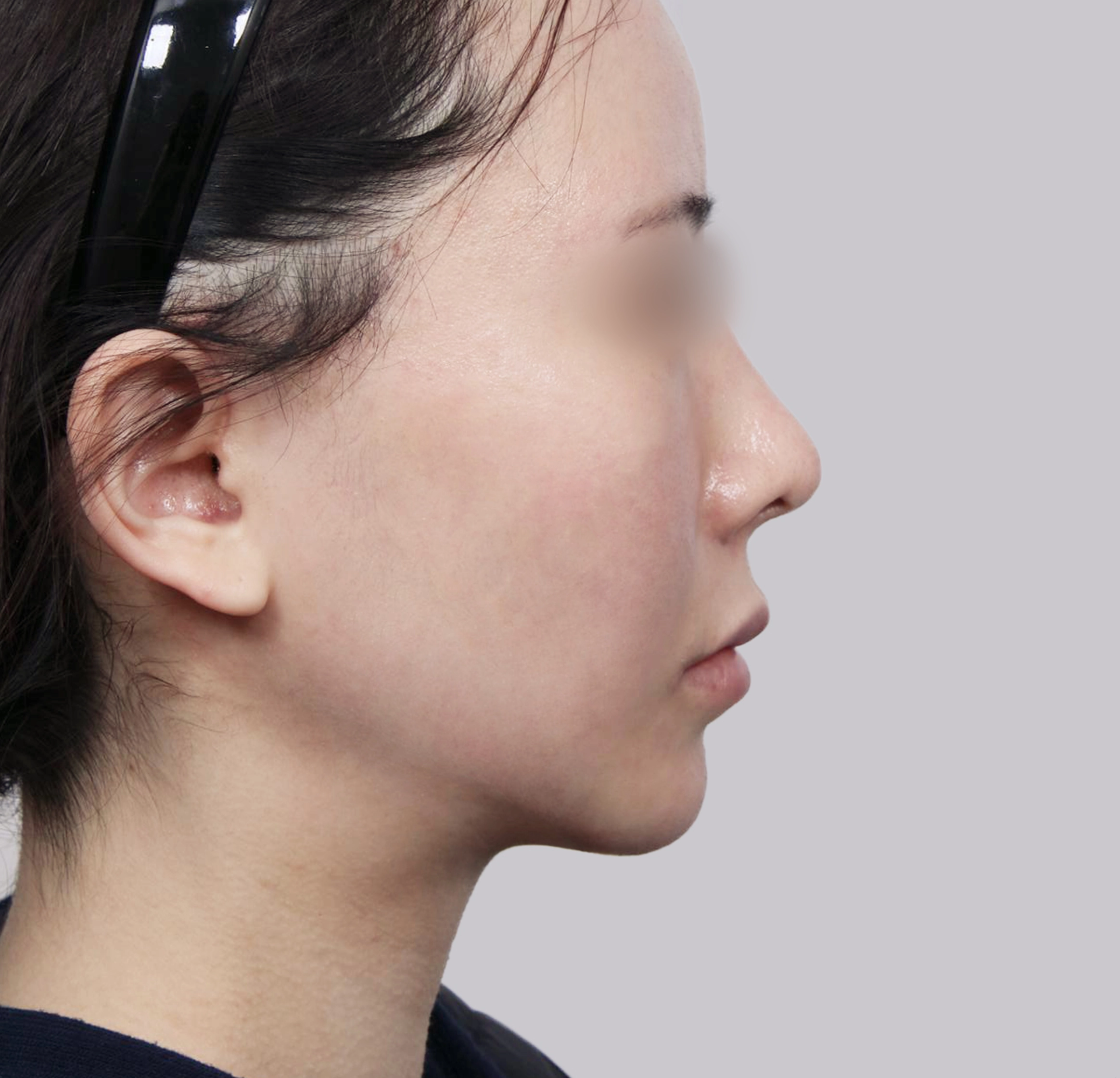 Căng Da Mặt Mini-측면-후