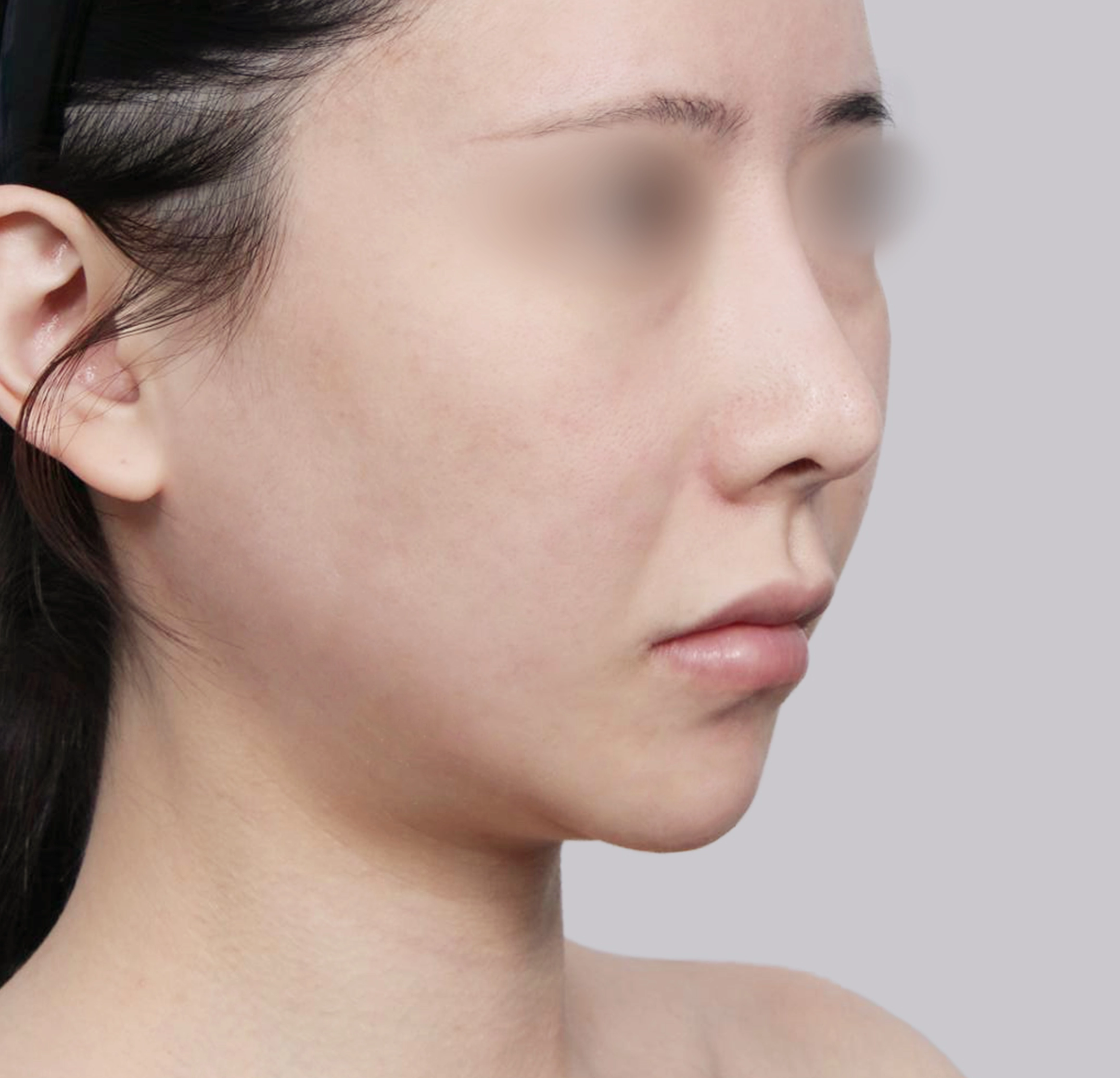 Căng Da Mặt Mini-45도-전