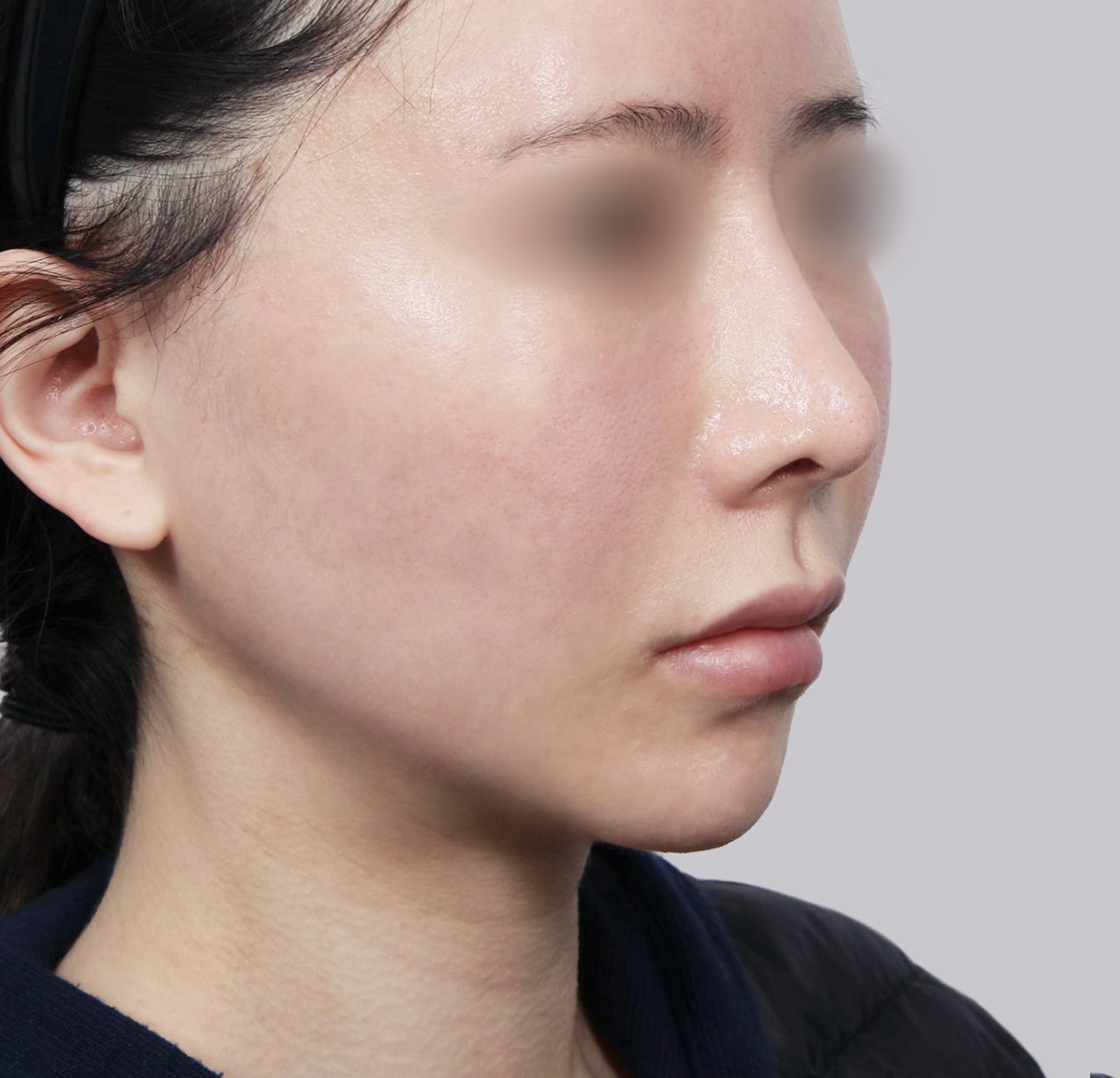 Căng Da Mặt Mini-45도-후