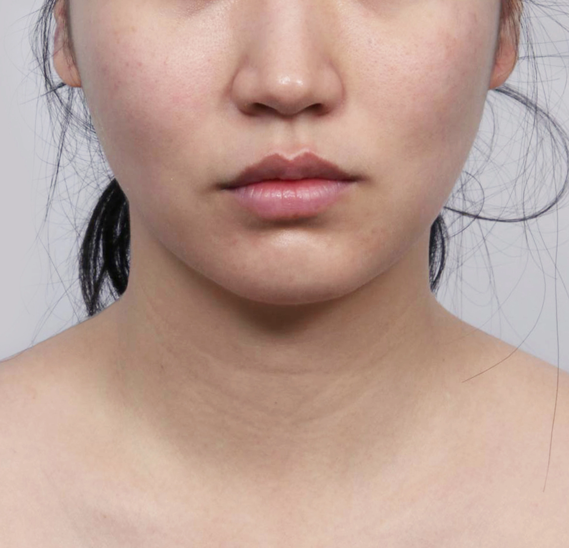 Căng Da Mặt Mini-정면-전