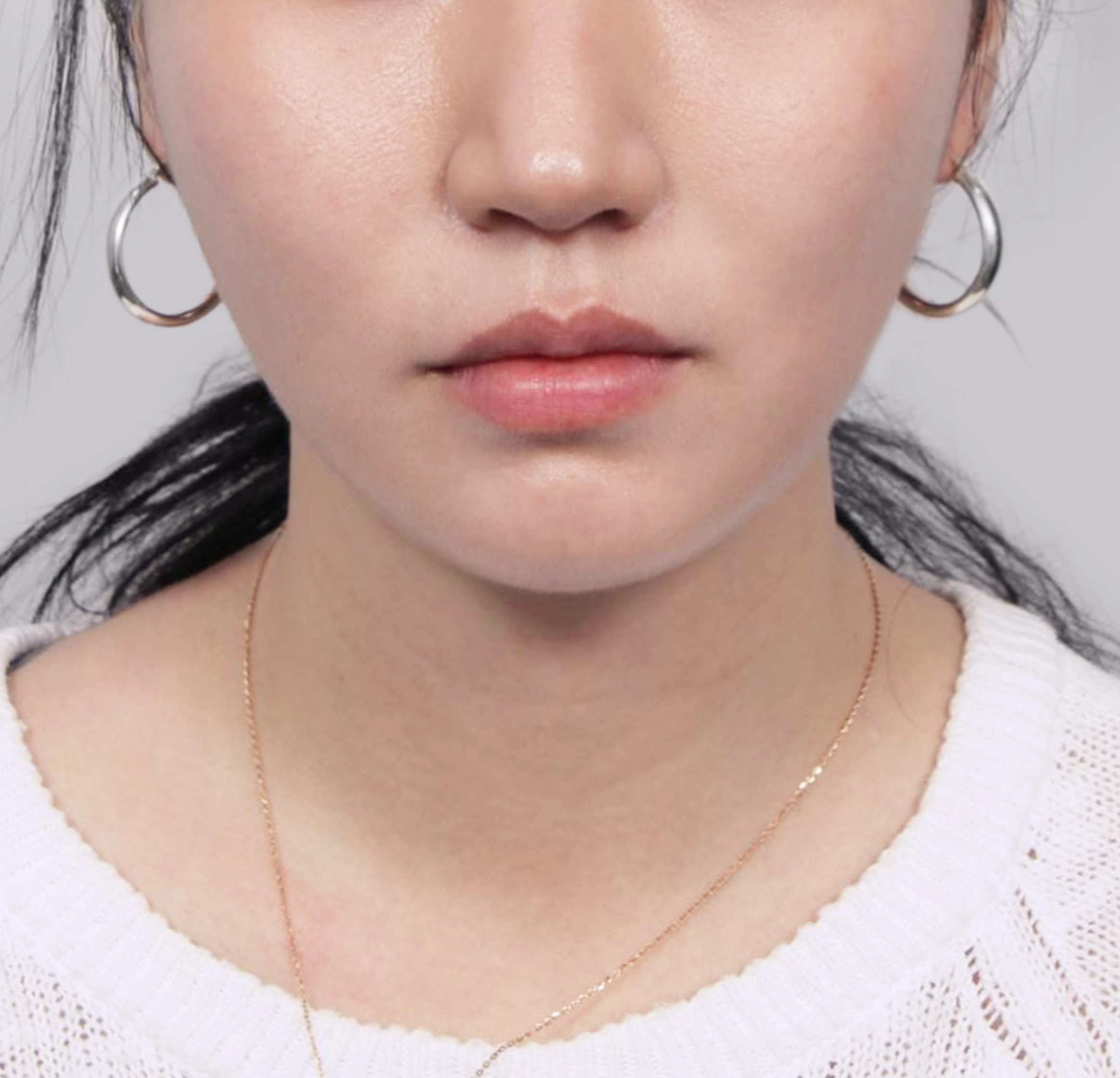 Căng Da Mặt Mini-정면-후