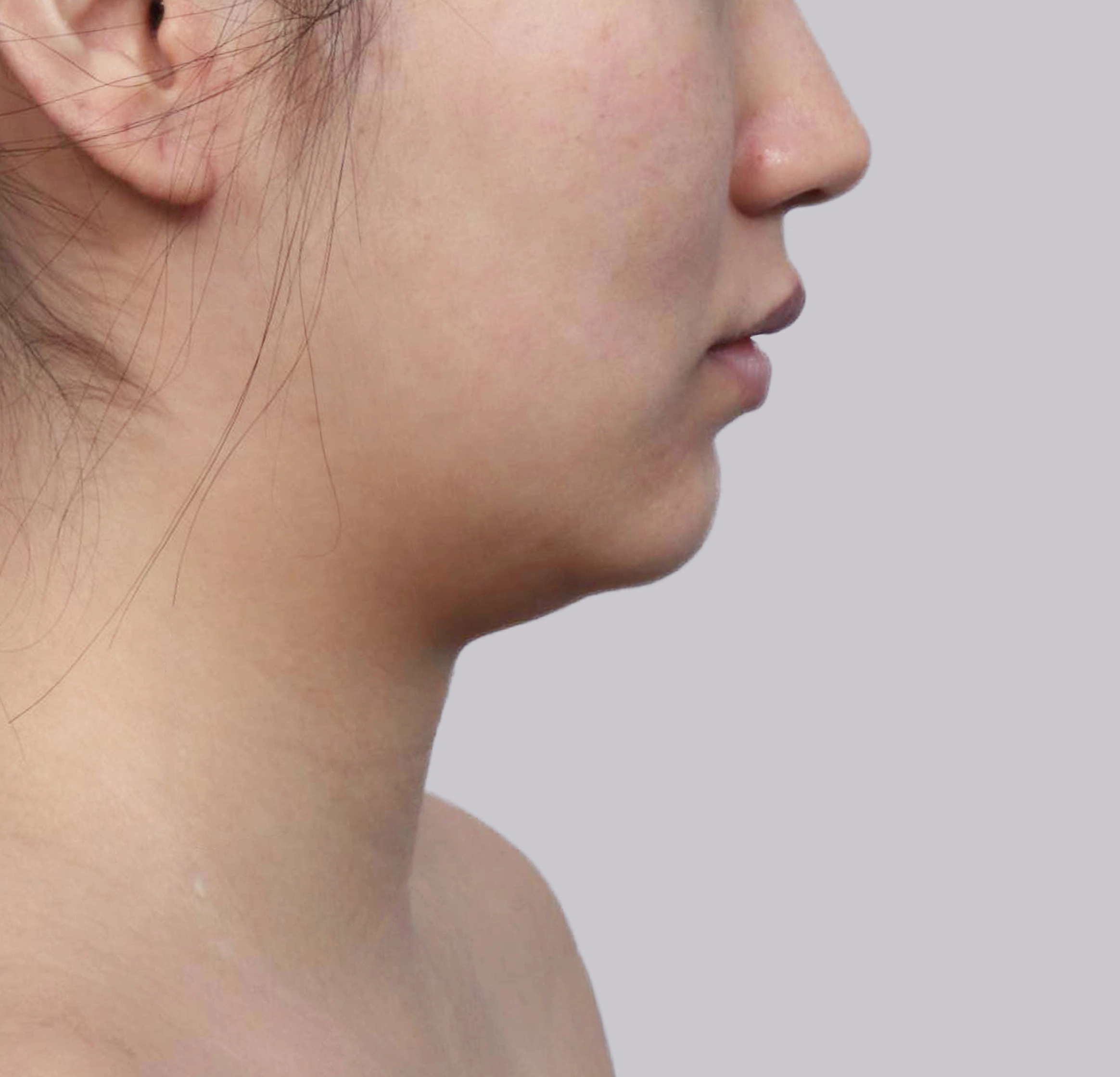 Căng Da Mặt Mini-측면-전