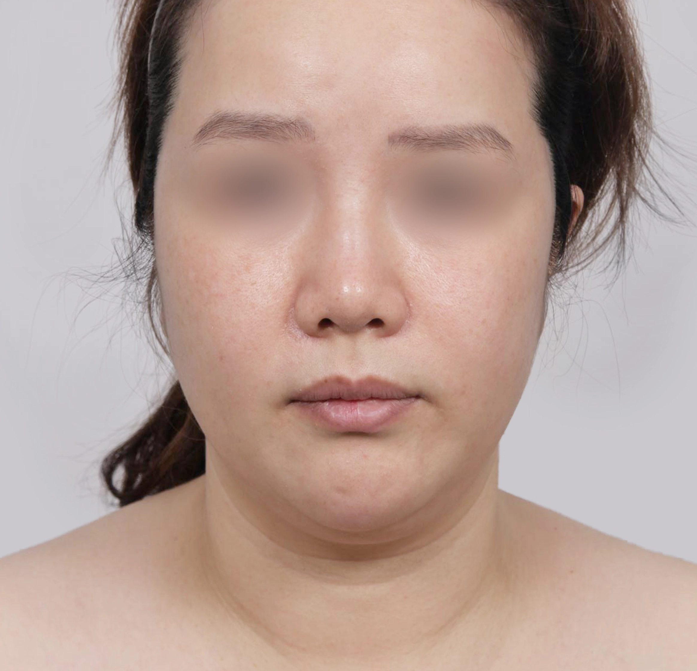 Căng Da Mặt Mini-정면-전