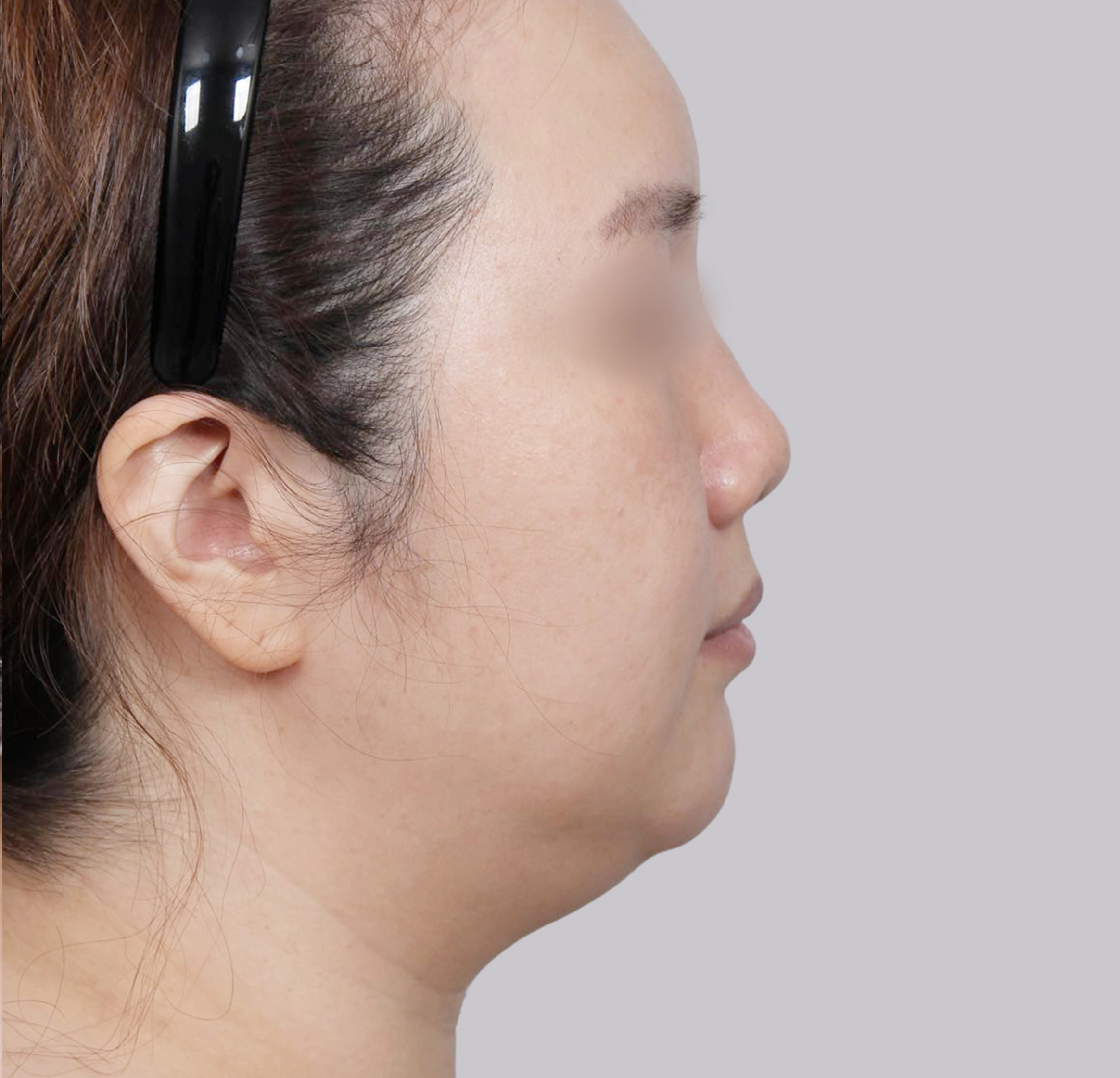 Căng Da Mặt Mini-측면-전