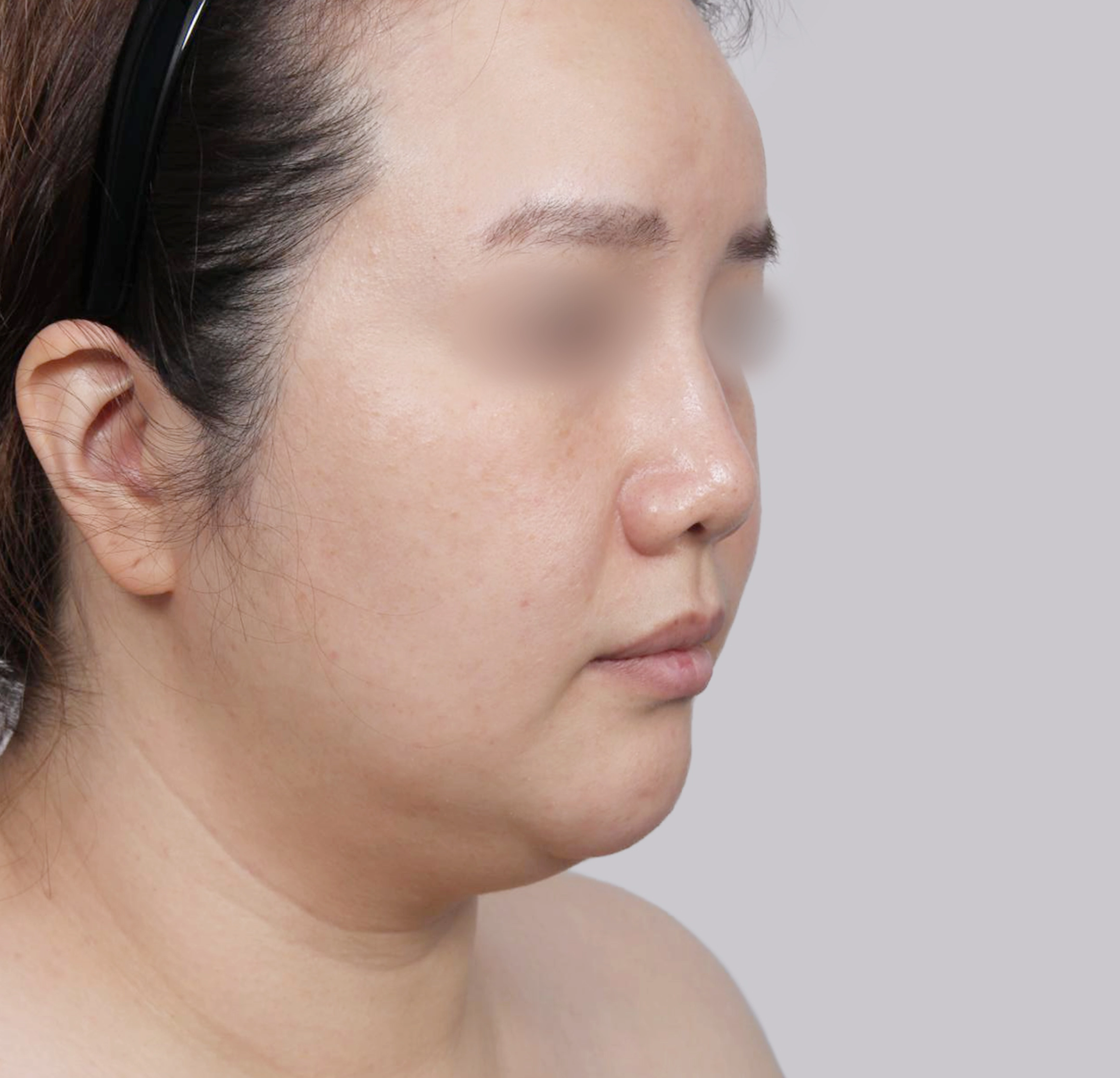 Căng Da Mặt Mini-45도-전