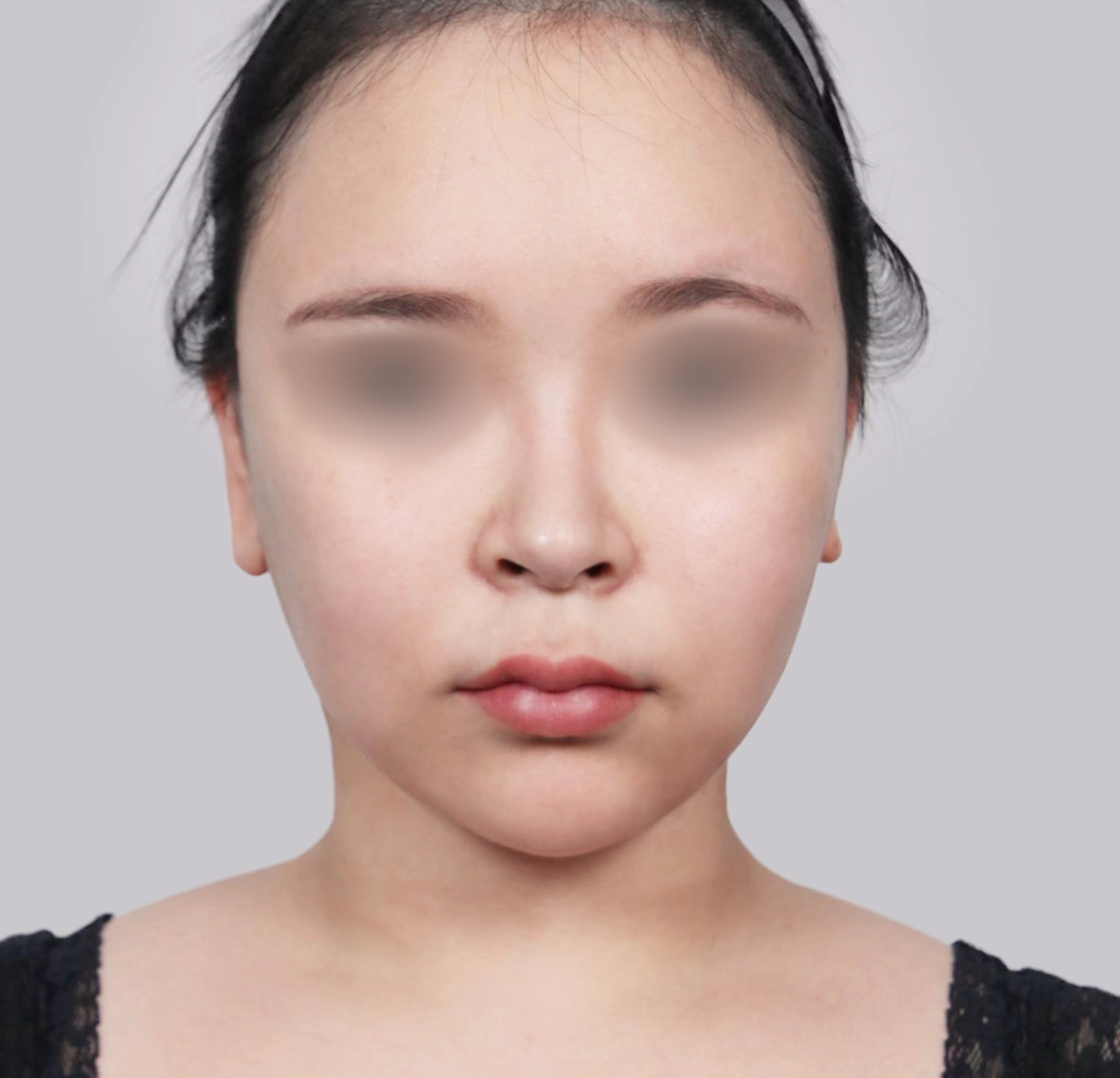 Căng Da Mặt Mini-정면-후