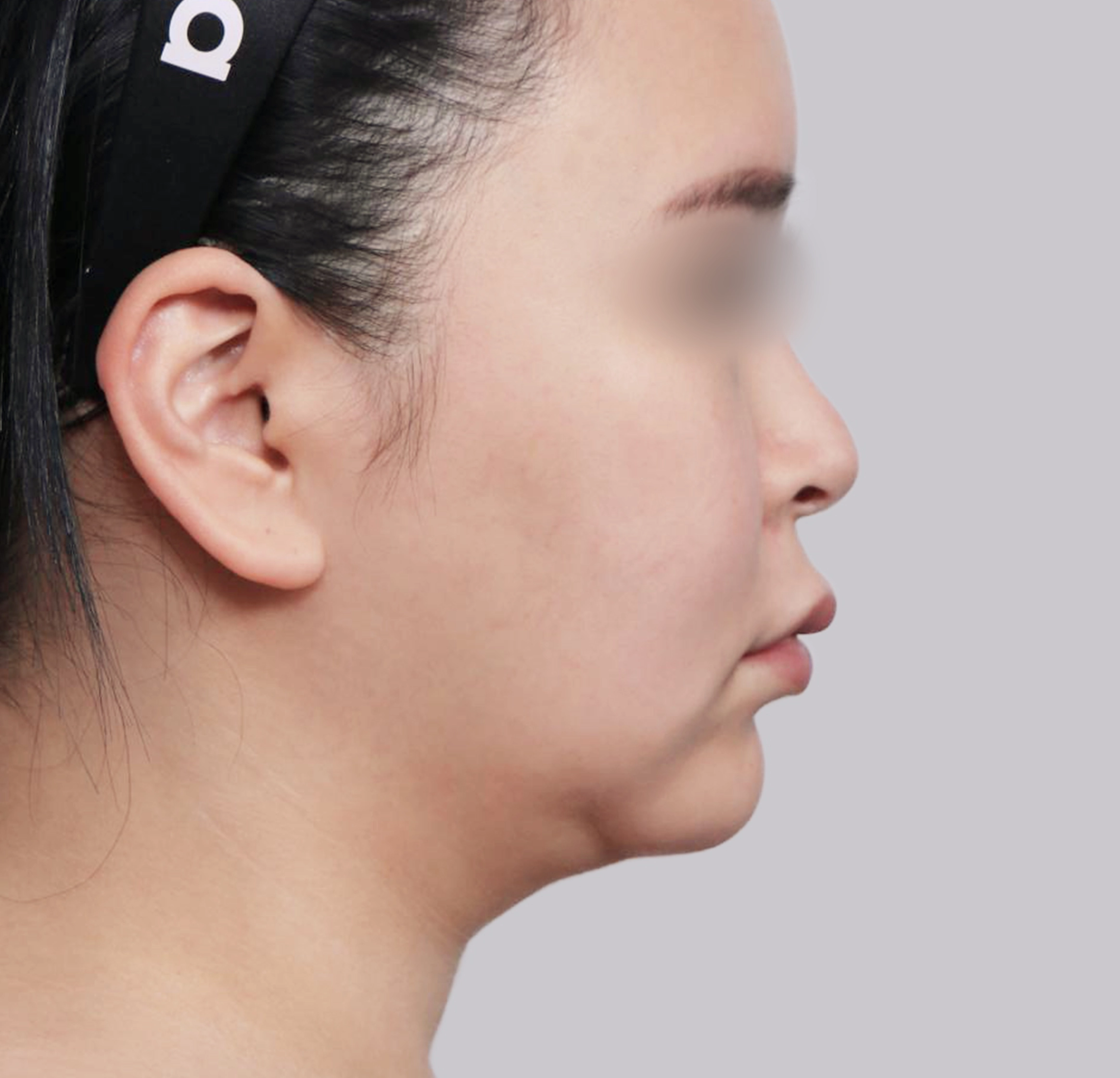 Căng Da Mặt Mini-측면-전