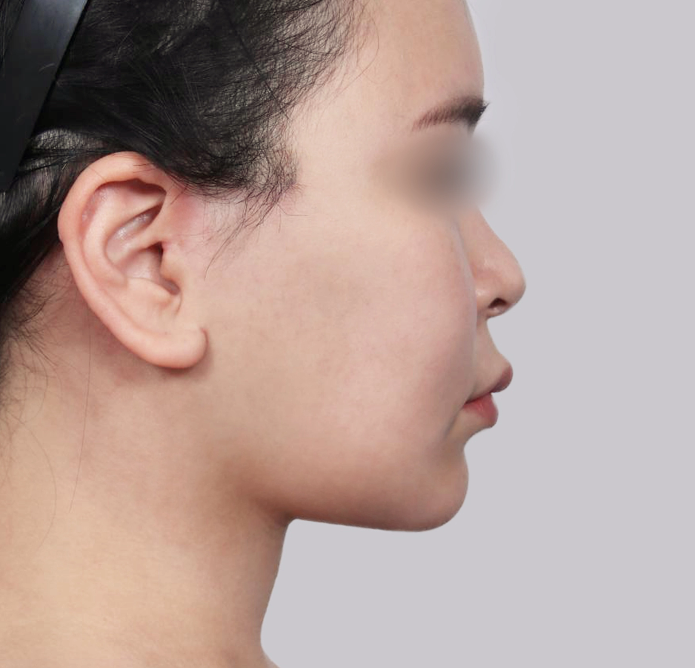 Căng Da Mặt Mini-측면-후