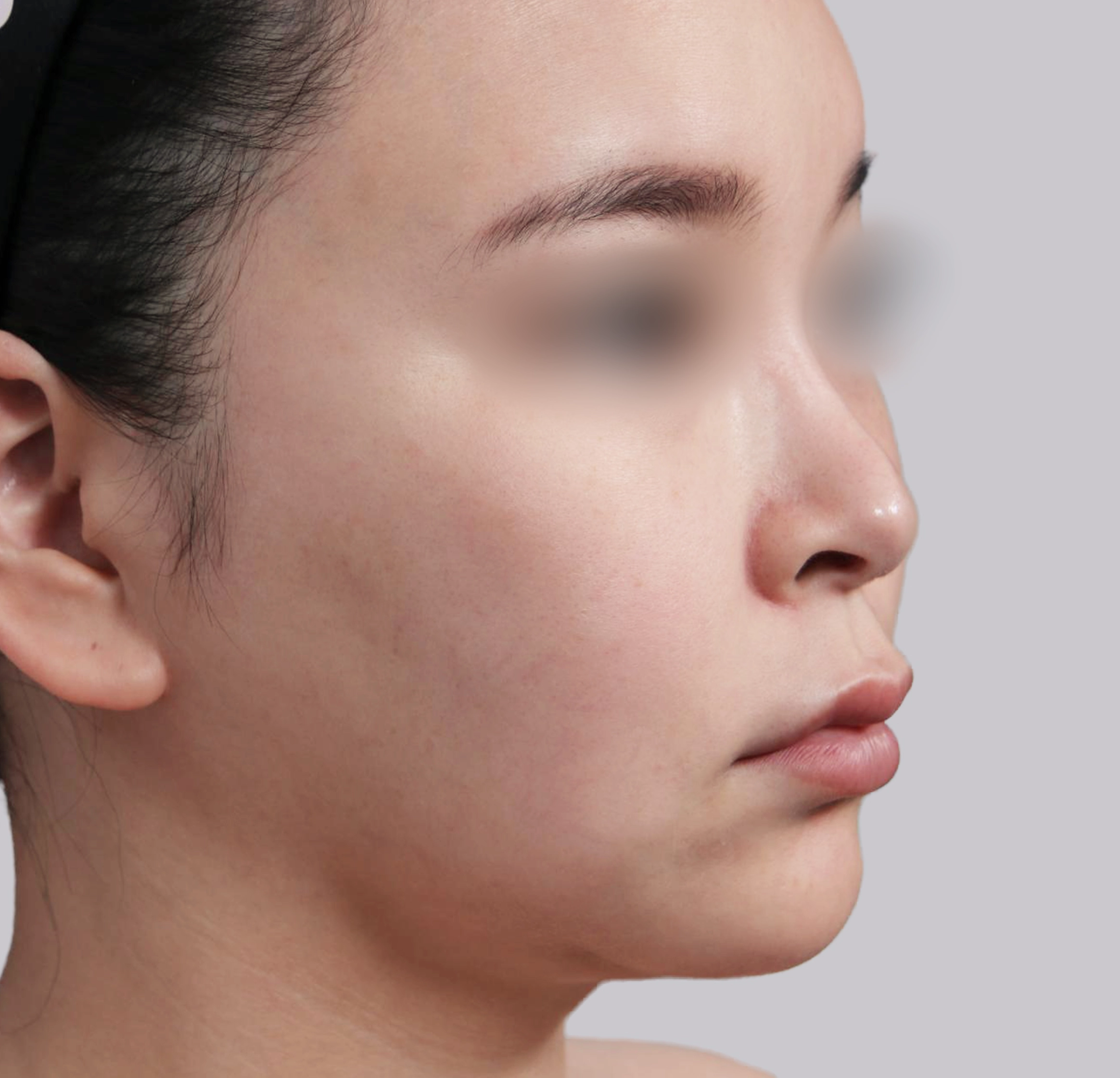 Căng Da Mặt Mini-45도-전