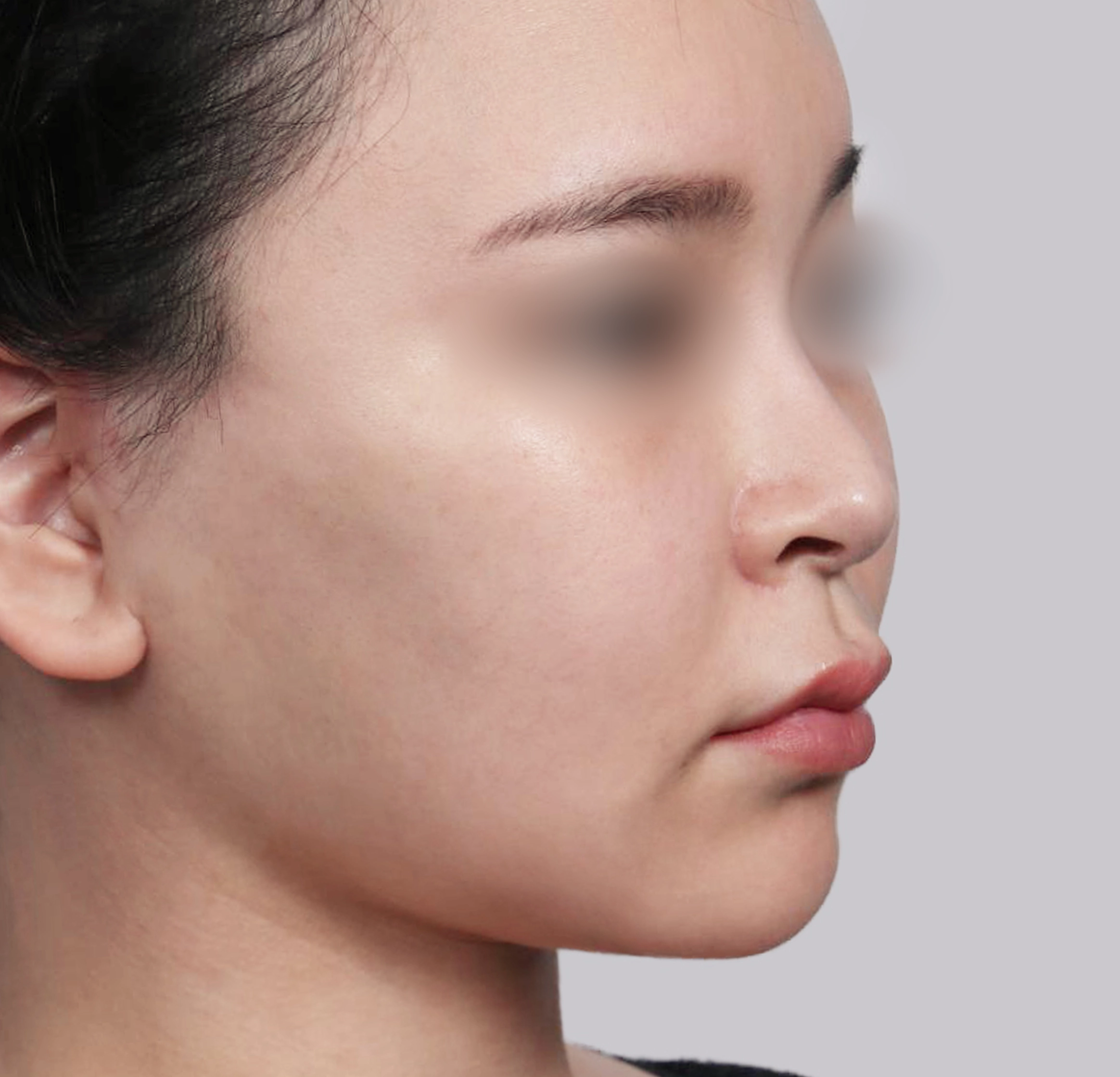 Căng Da Mặt Mini-45도-후