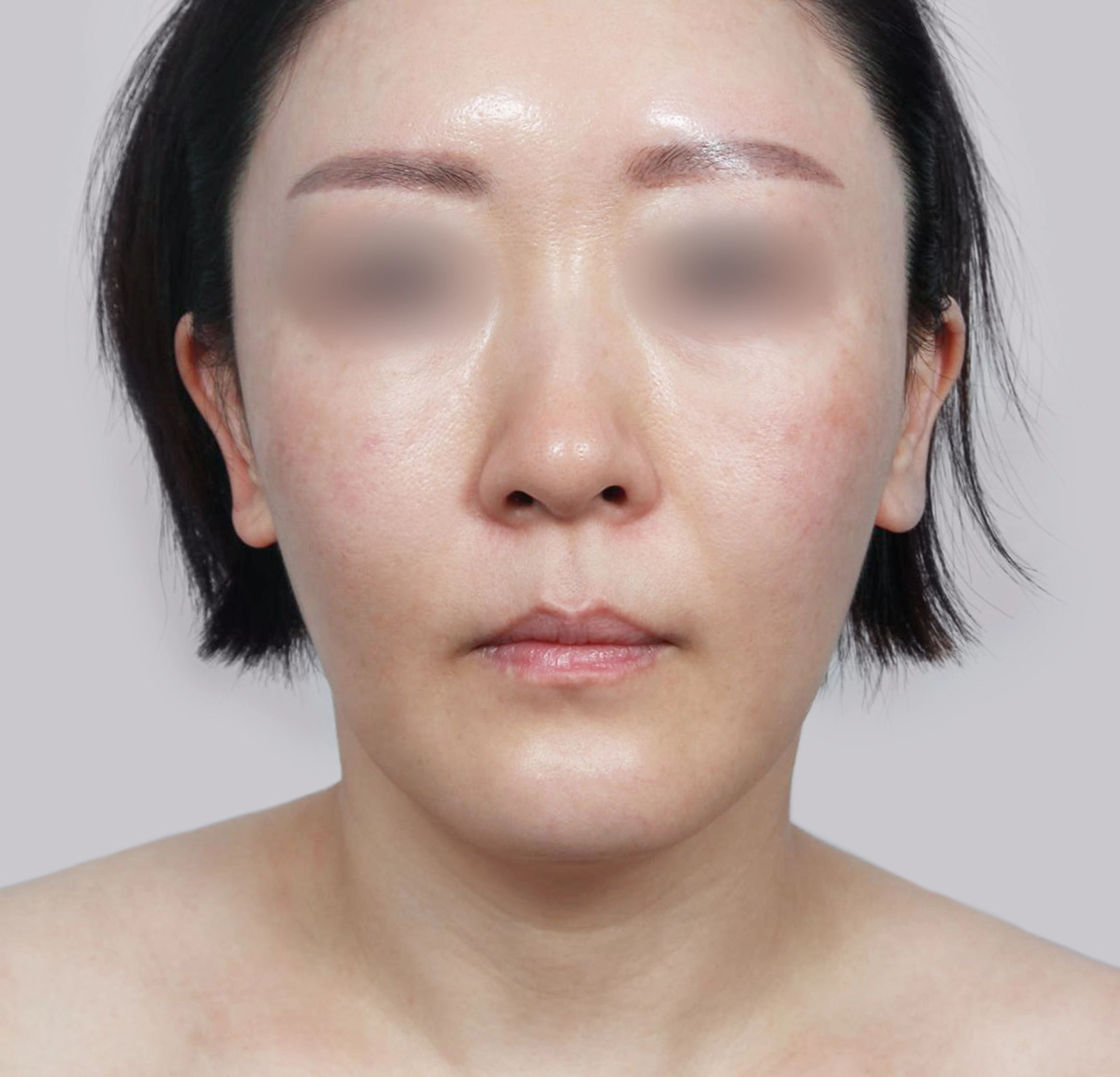 Căng Da Mặt Mini-정면-전