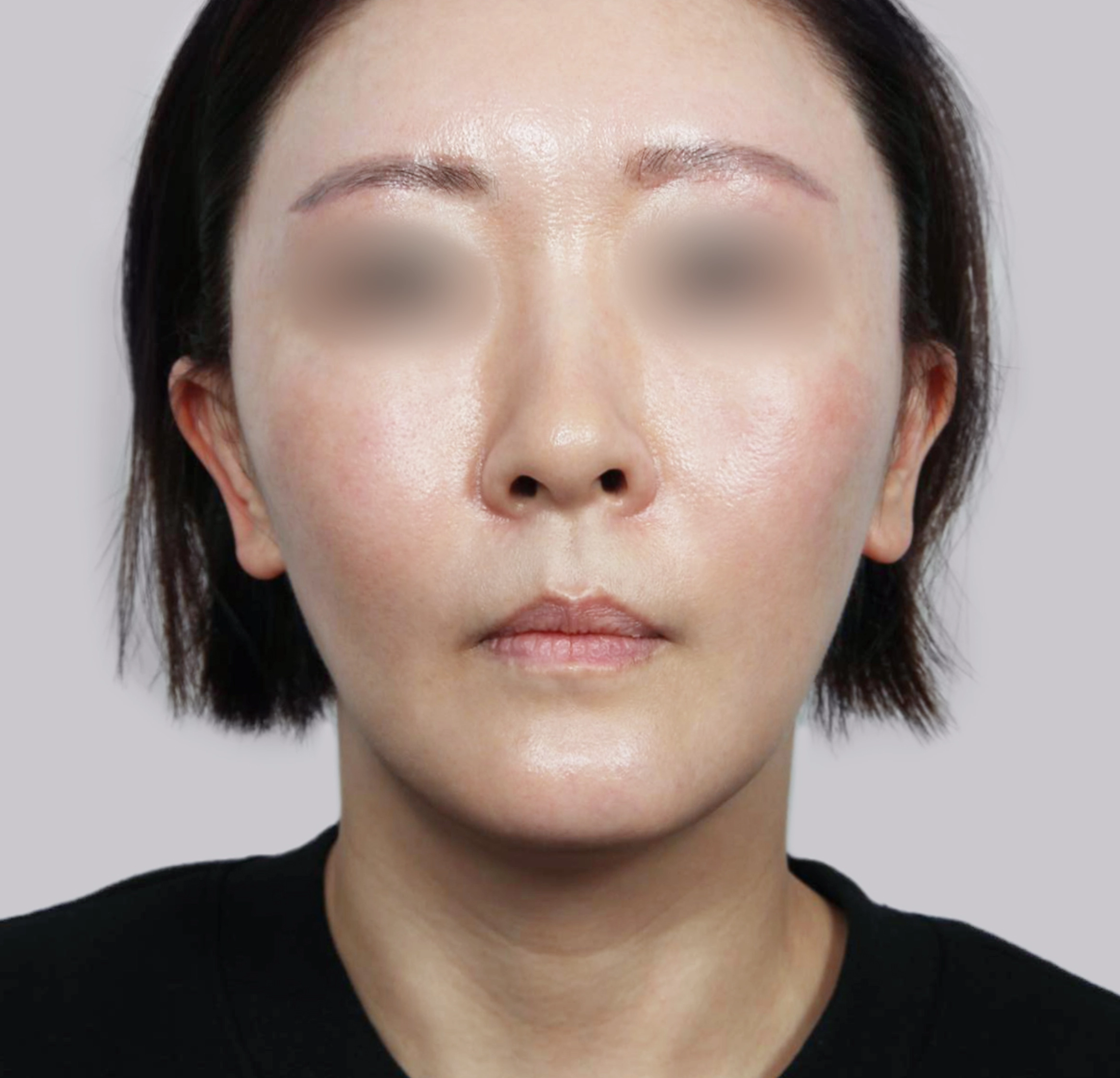 Căng Da Mặt Mini-정면-후