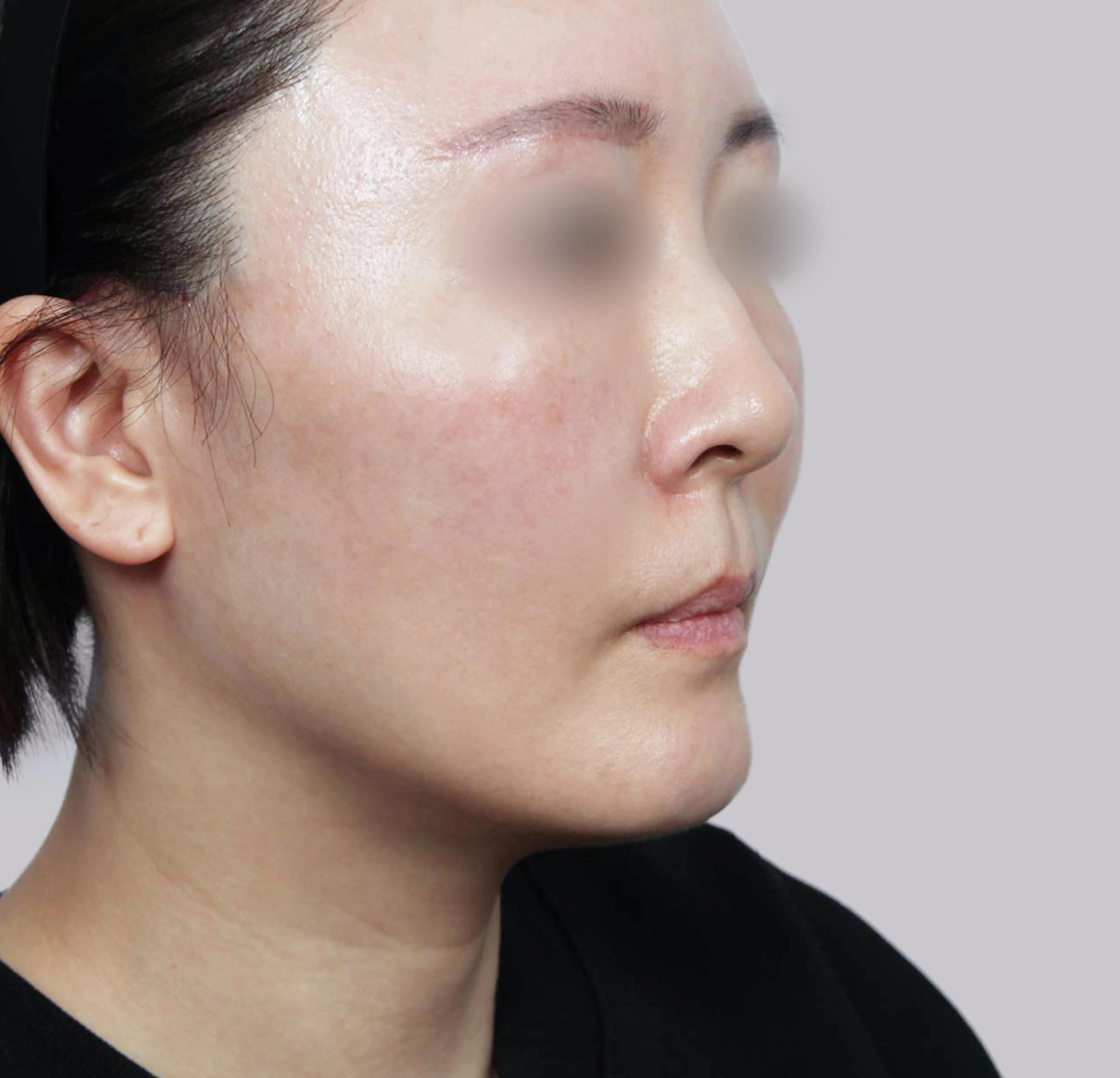 Căng Da Mặt Mini-45도-후