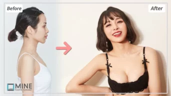 Trước và sau khi nâng ngực ) || ngực chảy xệ